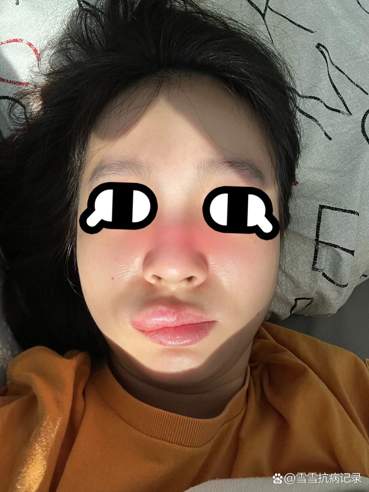 早上起来突然嘴肿了