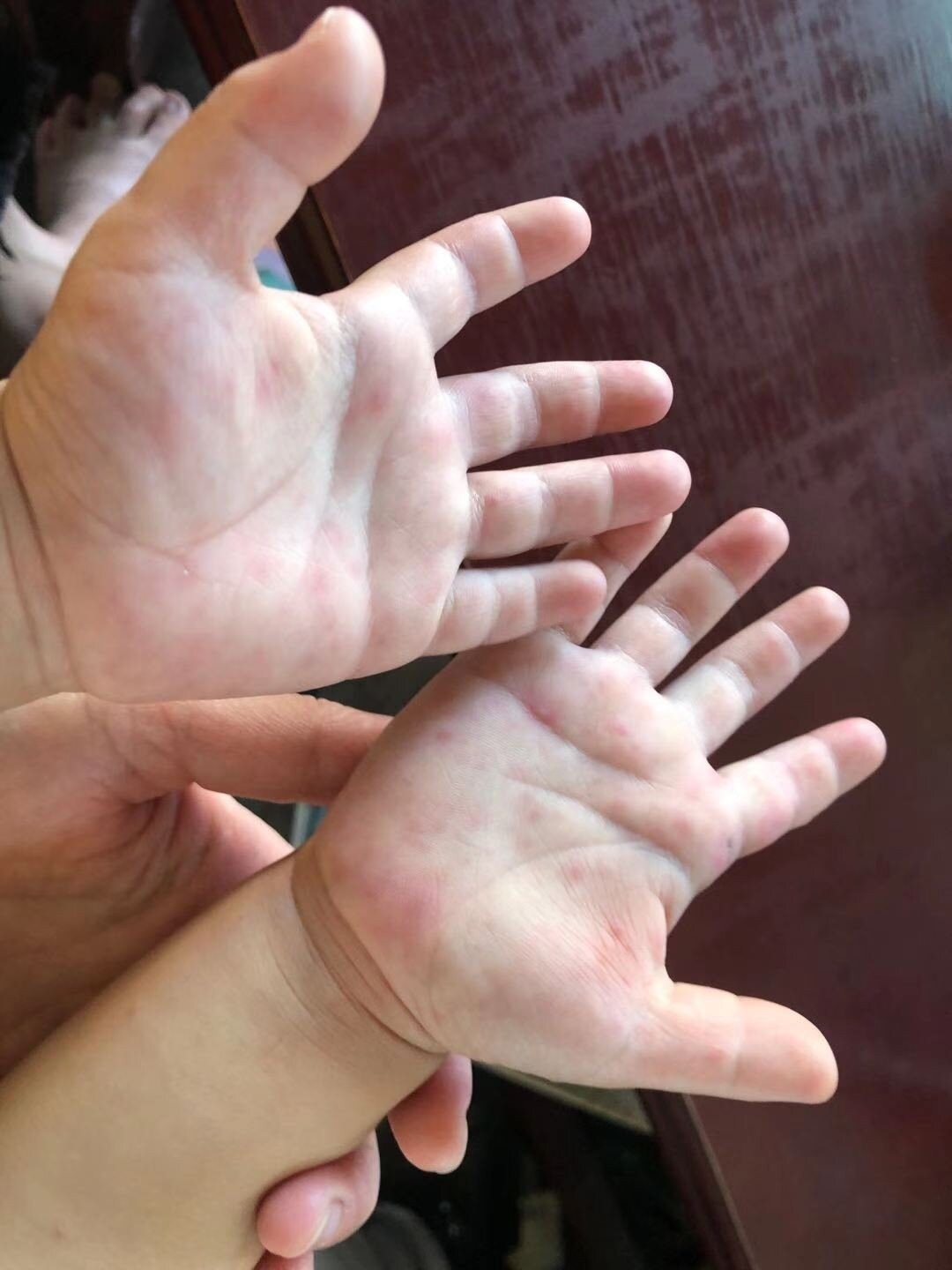 孩子手足口病的皮疹表现,家长了解一下