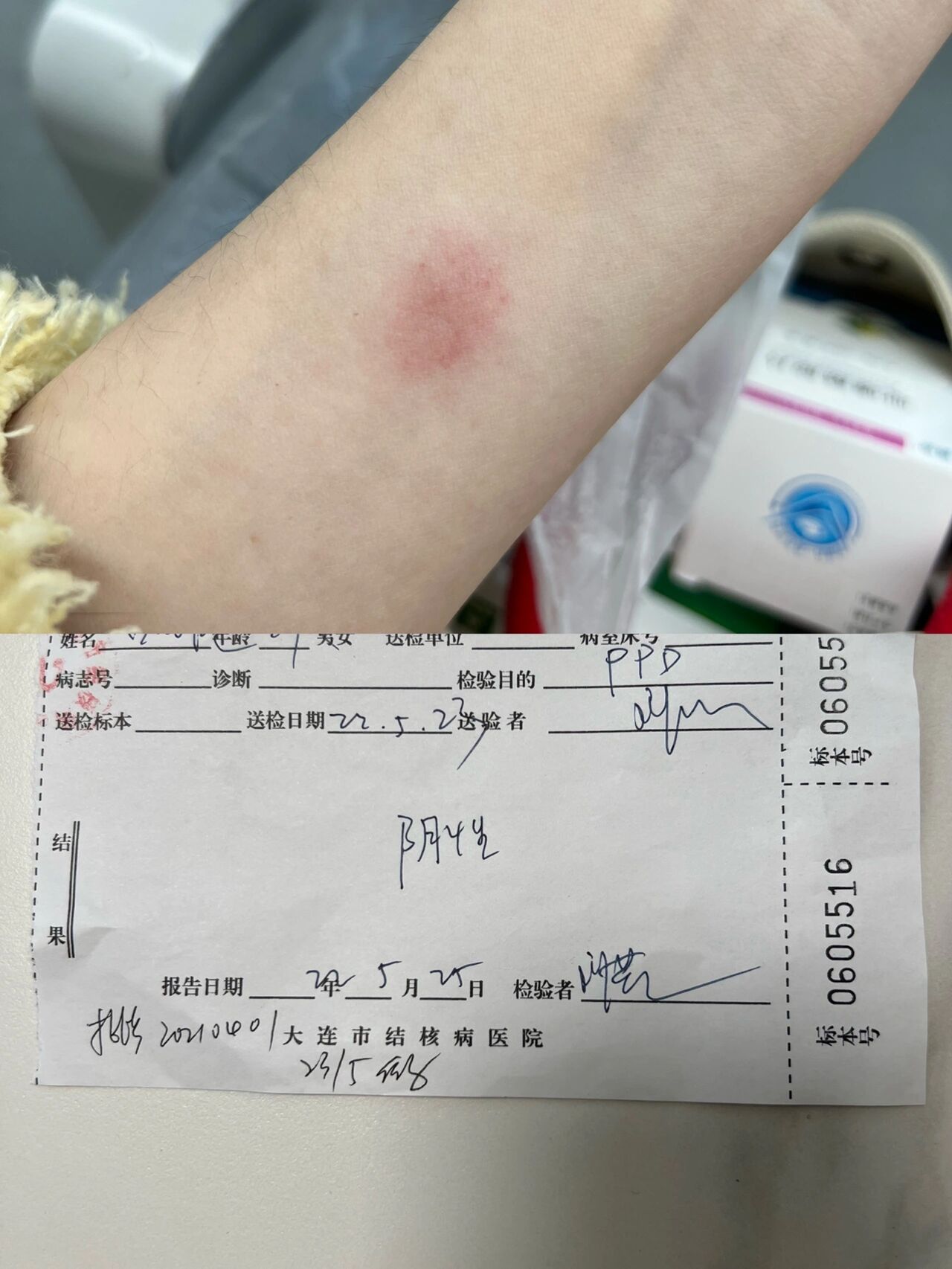 结节性红斑