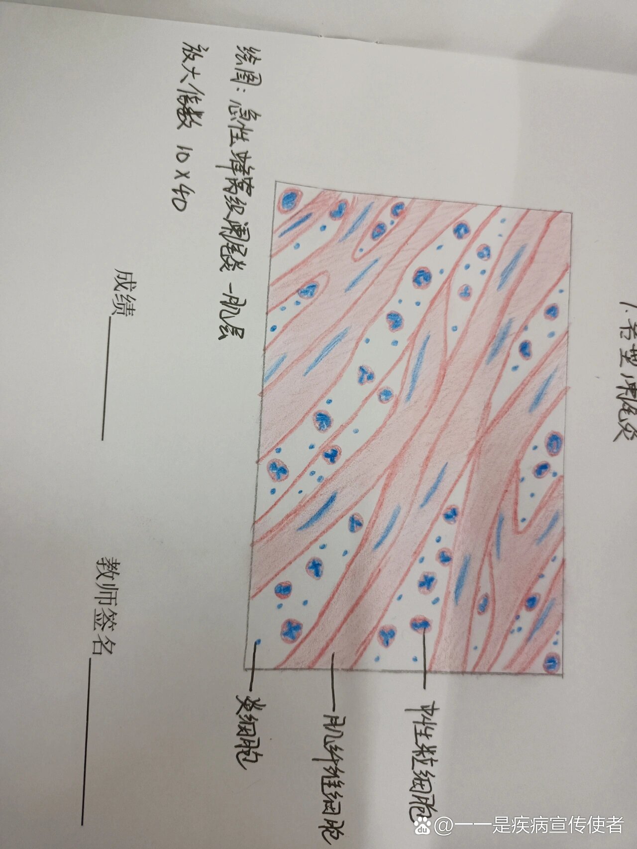 急性蜂窝织阑尾炎