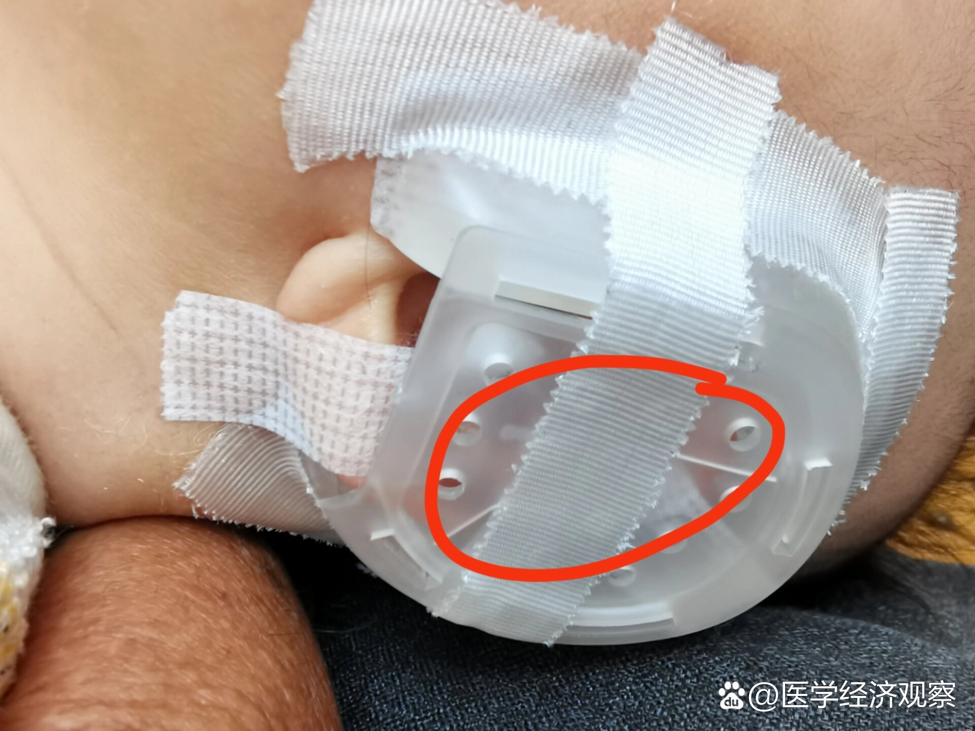 两个半月才开始环缩耳矫正