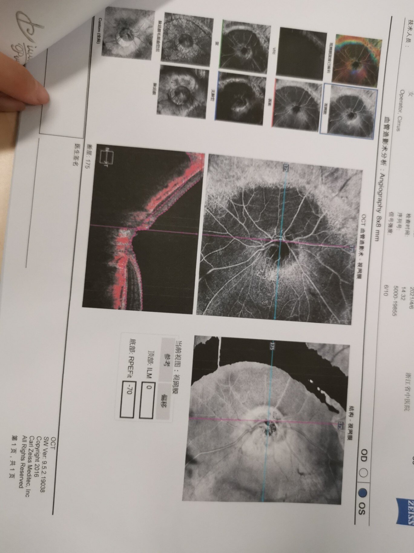 我第二天先去了浙一挂了个普通号眼科门诊任培方的医生,她给我做了oct