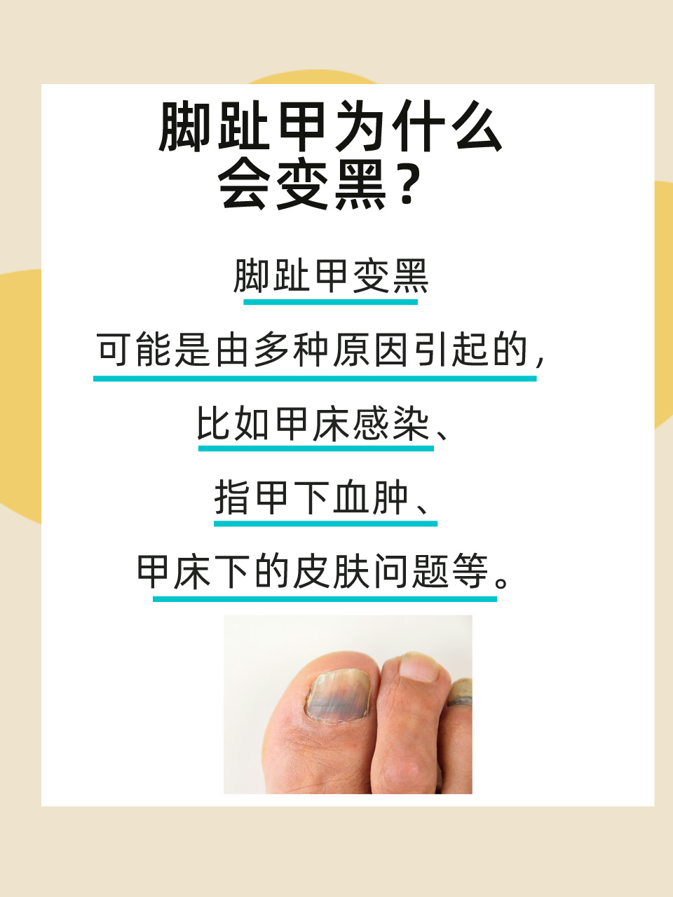 脚趾甲变黑:医生告诉你怎么办!