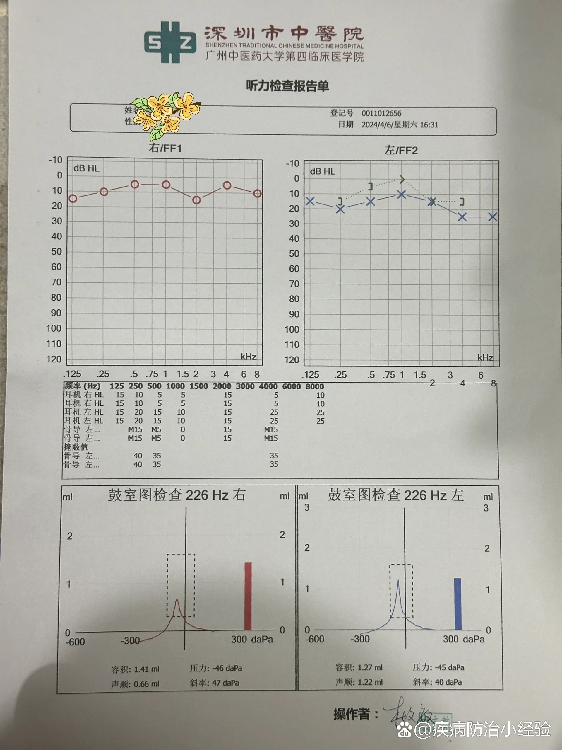 突发性耳聋后续