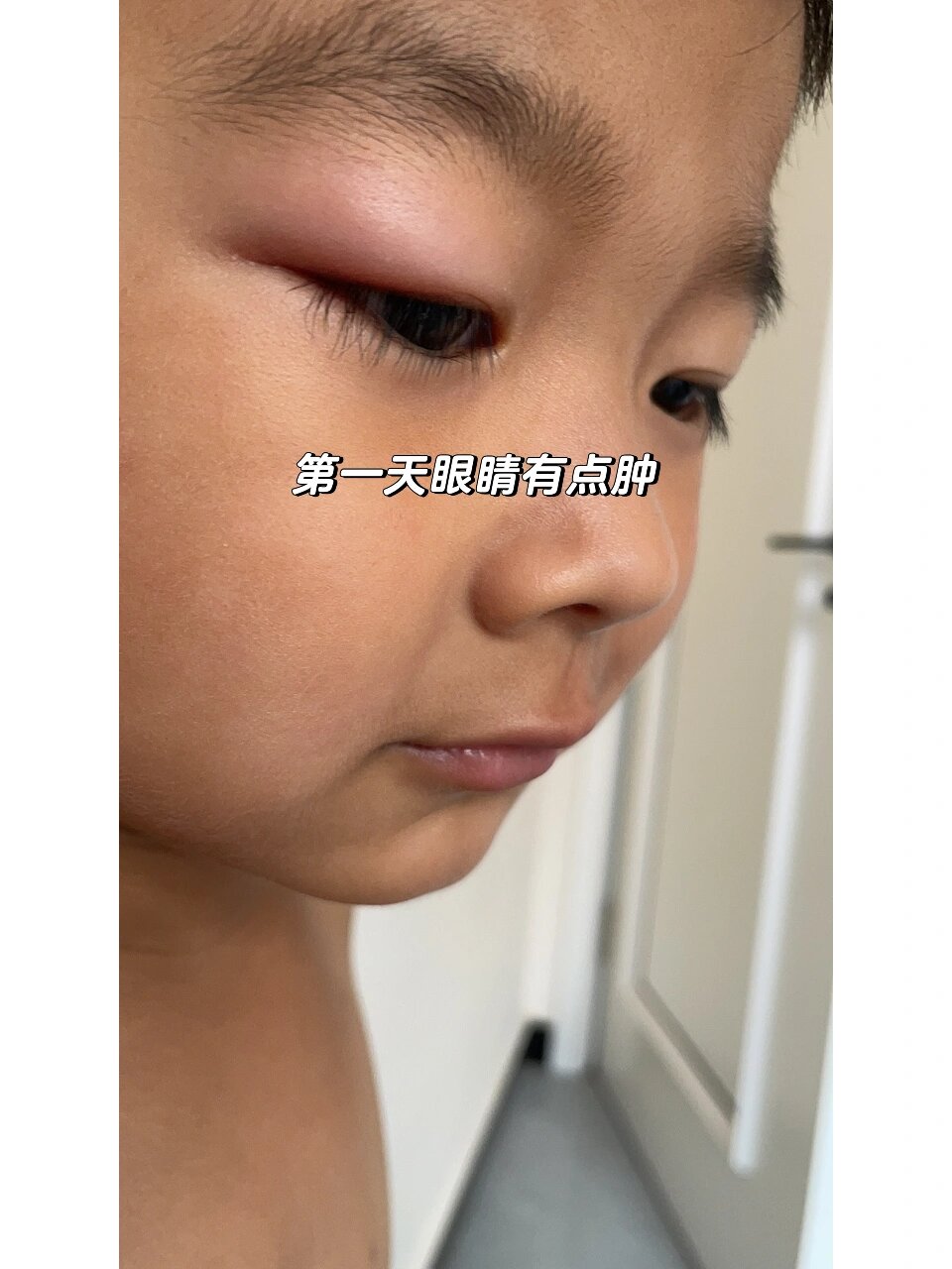 四周岁男孩麦粒肿恢复过程