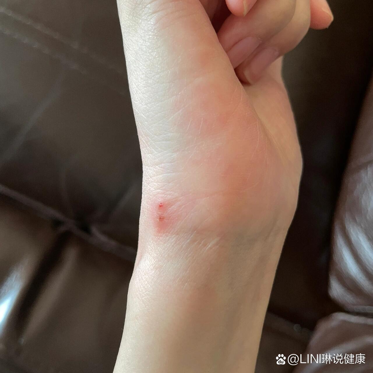 是不是被蟑螂咬了