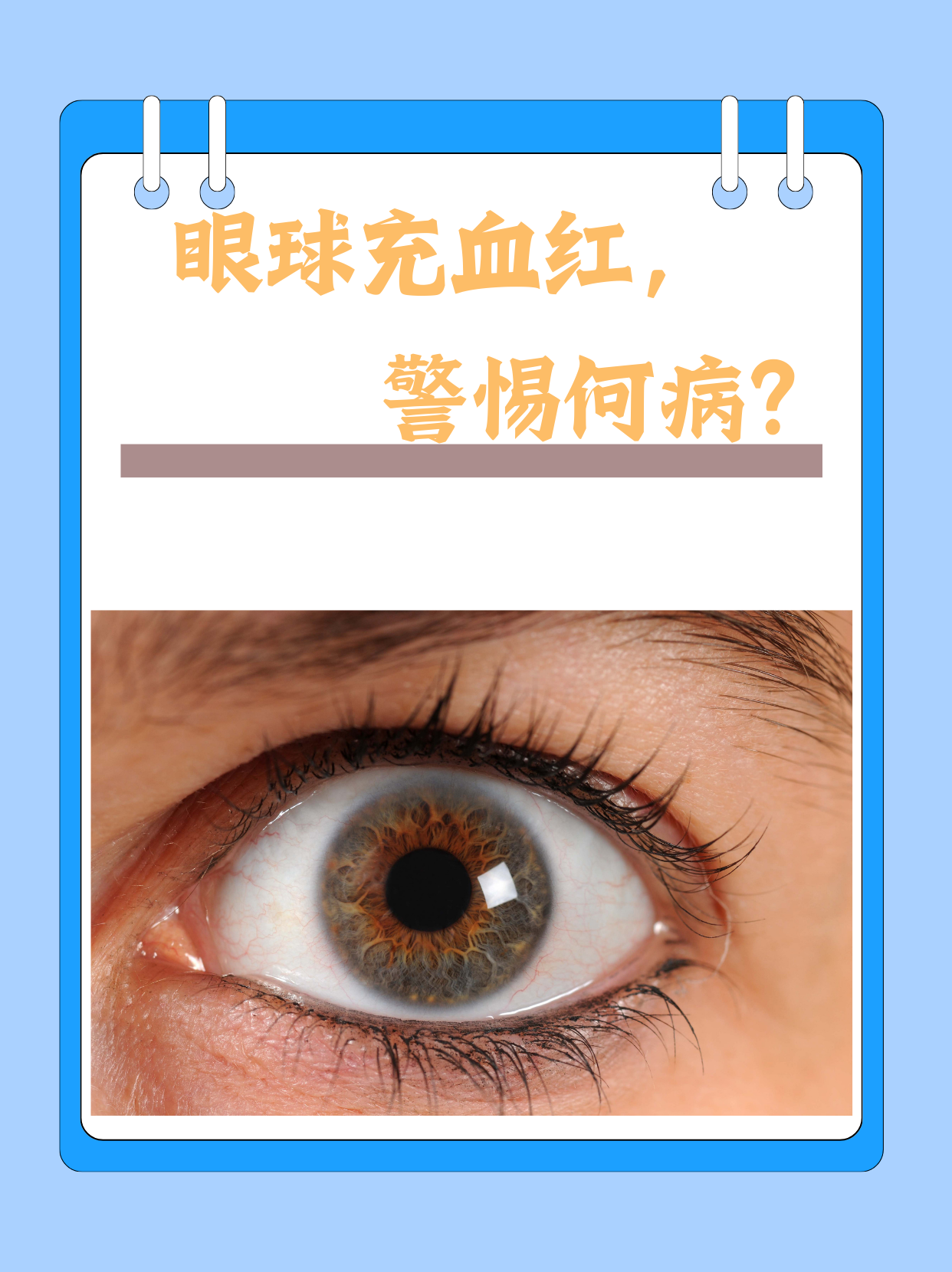 眼睛充血怎么办图片
