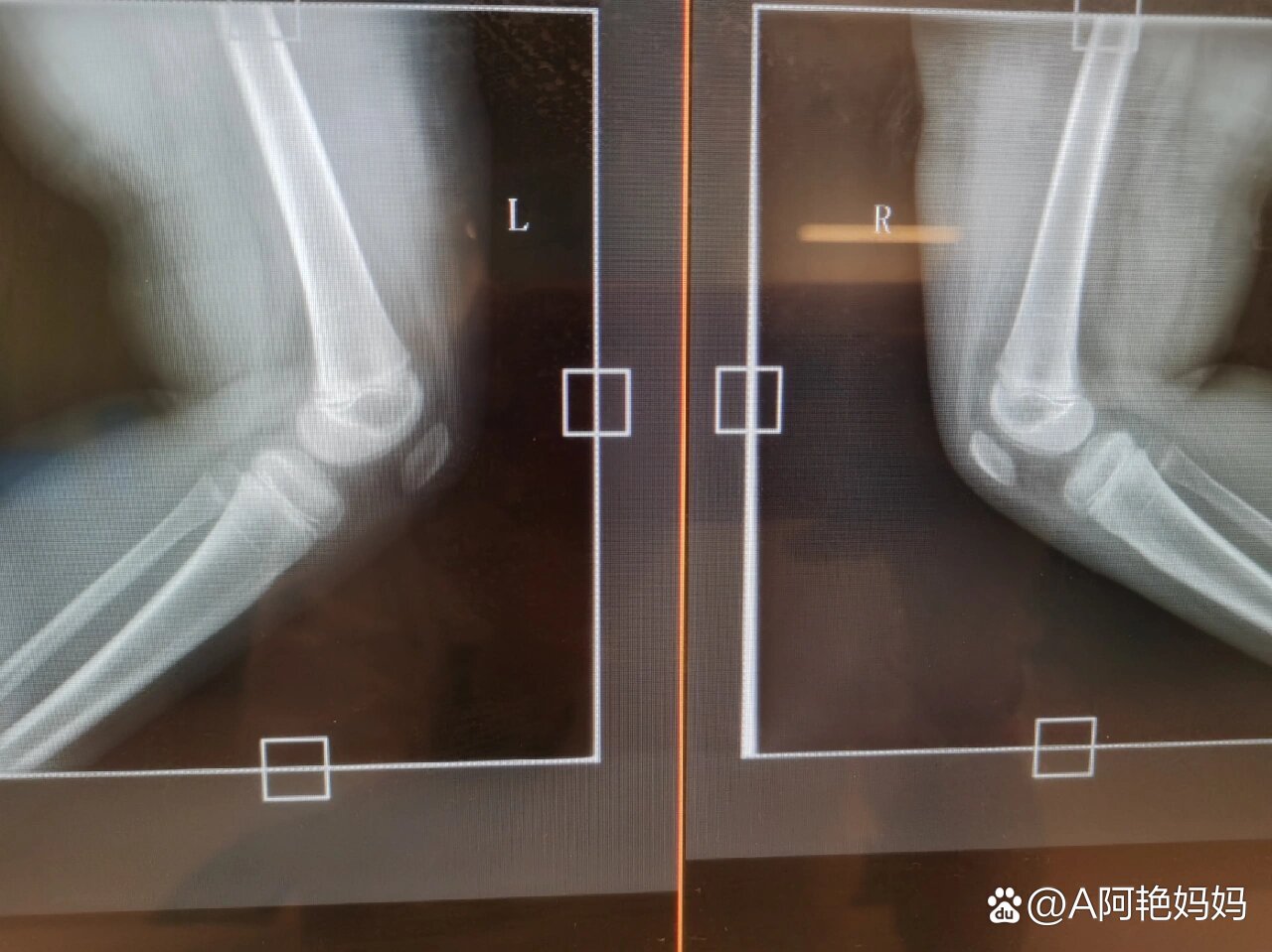 还算是标准的膝关节侧位片