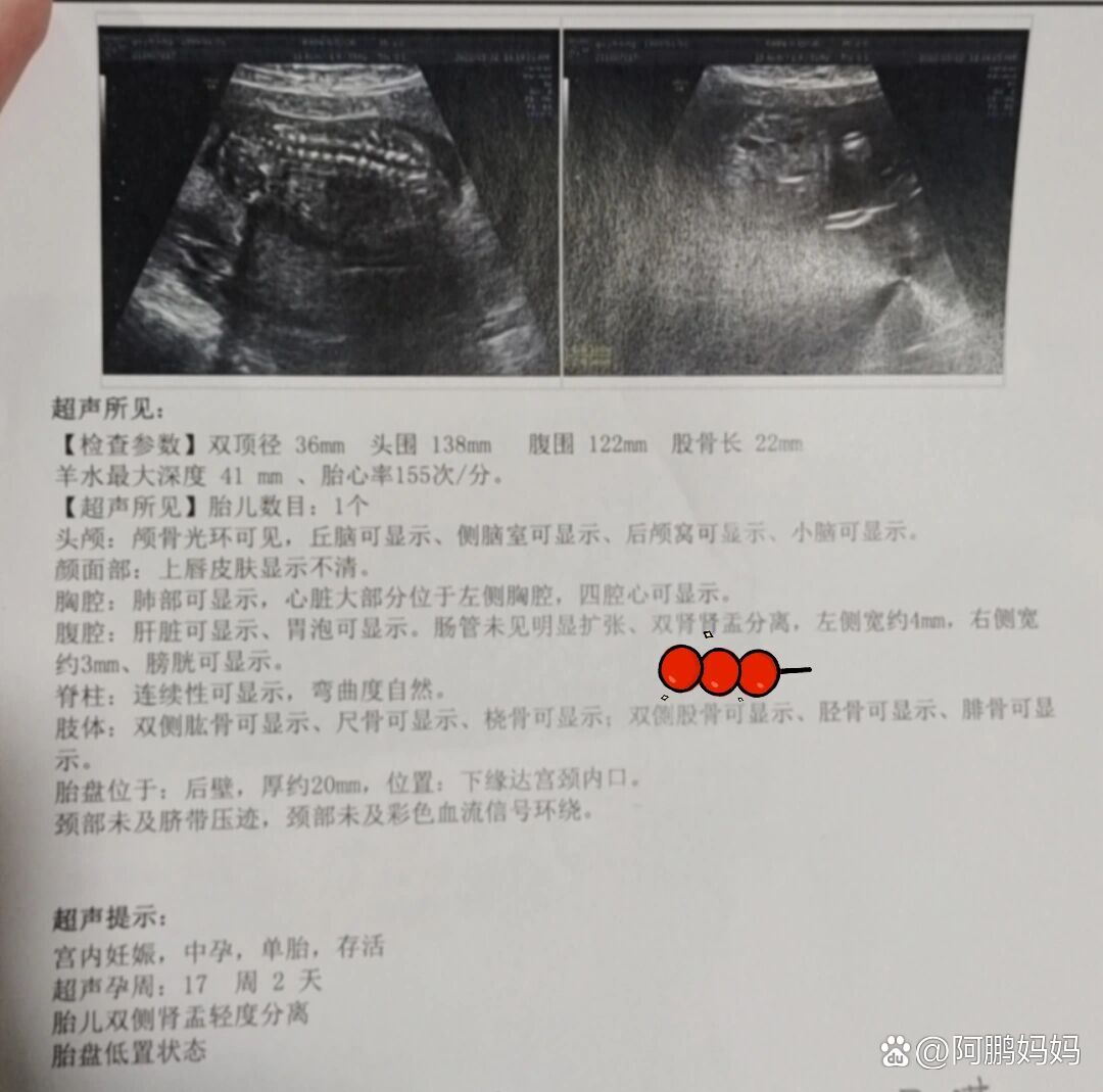 孕妈妈们,17周b超显示双肾肾盂分离,有没有一样的,具体是啥这个医生就