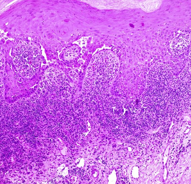 副肿瘤型天疱疮图片