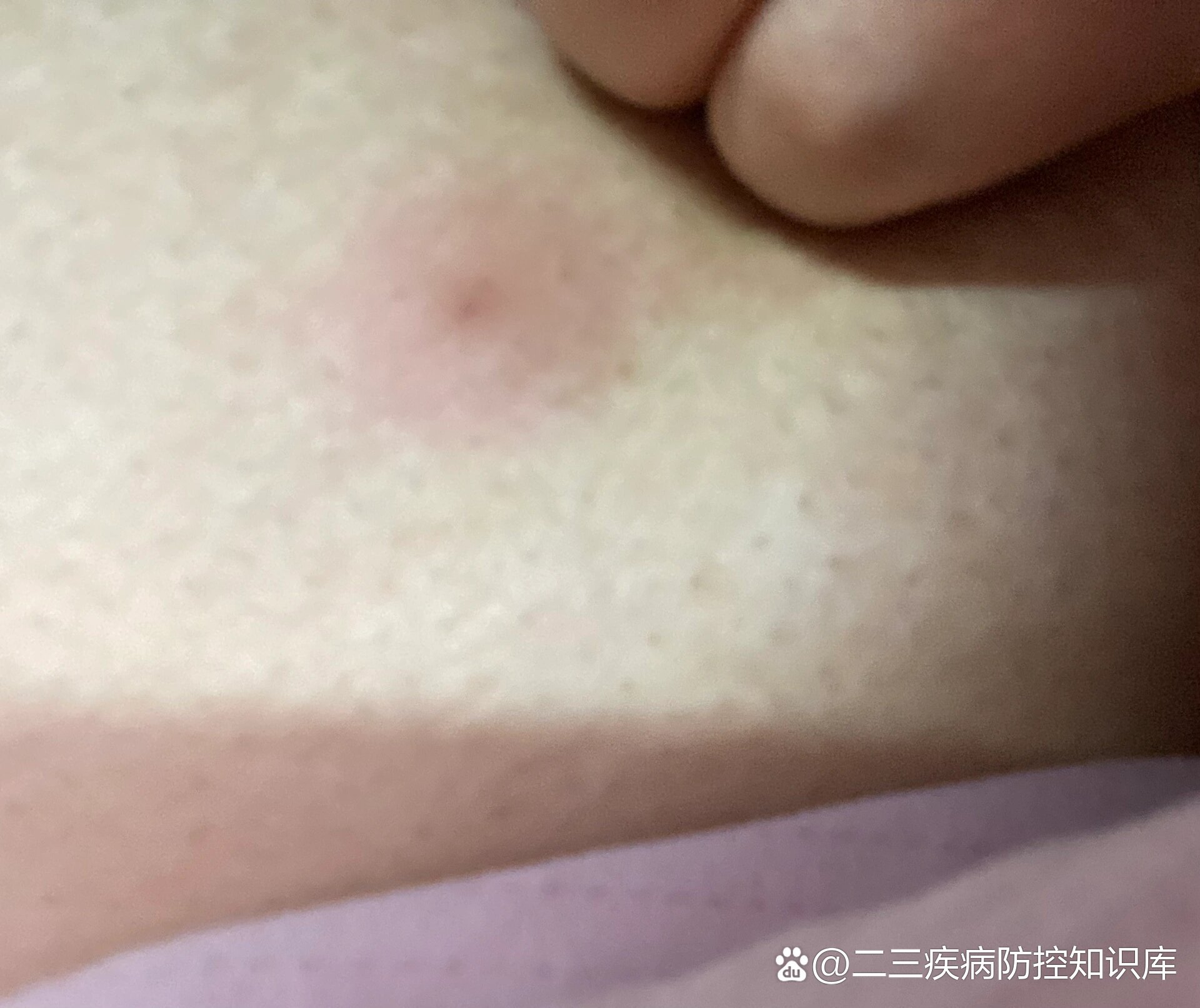 乳房里有小疙瘩图片