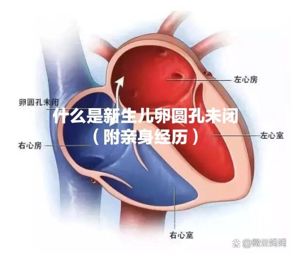 卵圆孔未闭解剖图图片