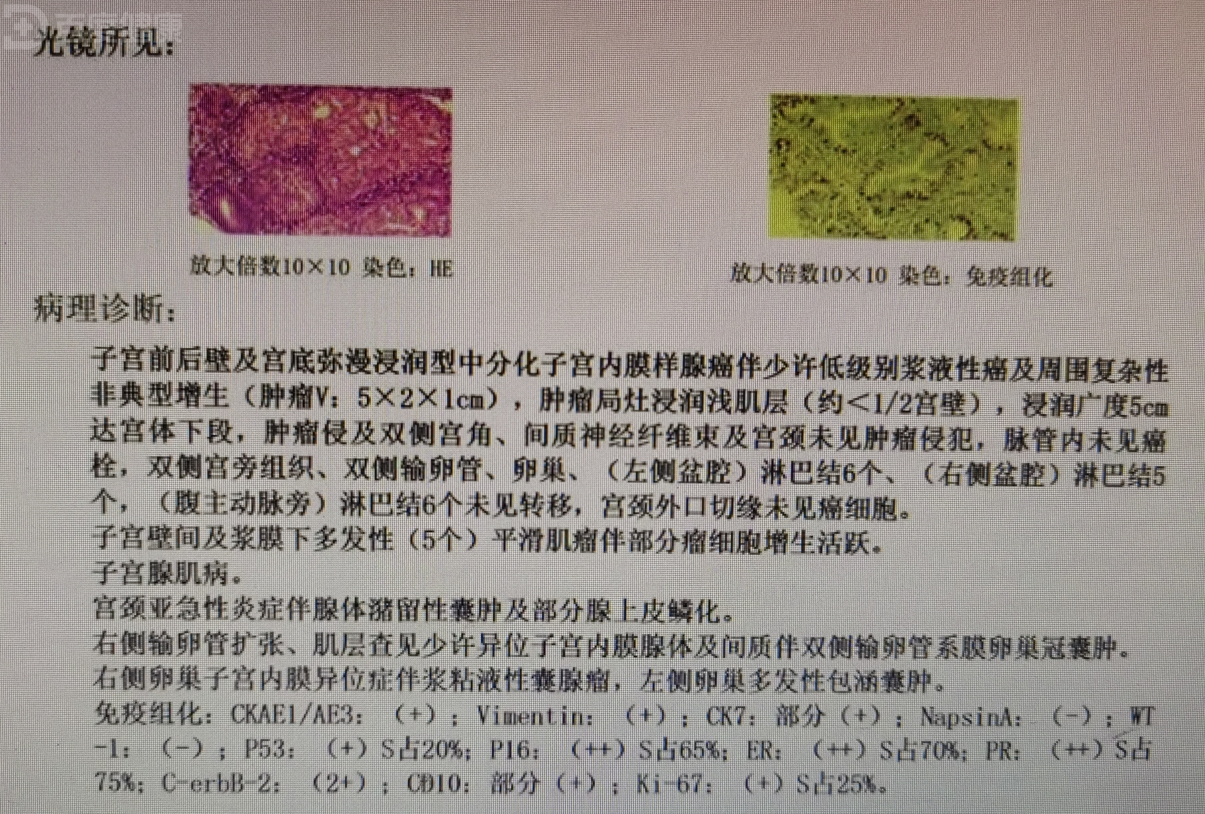 子宫内膜癌诊刮物图片图片