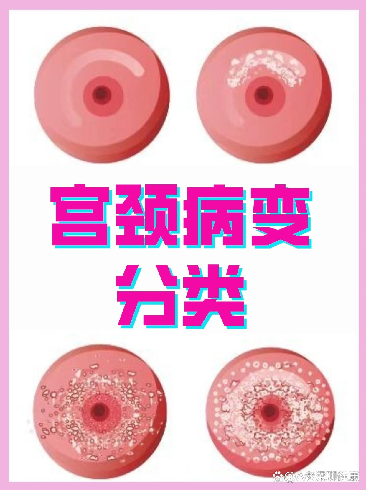 98宫颈病变的分类71