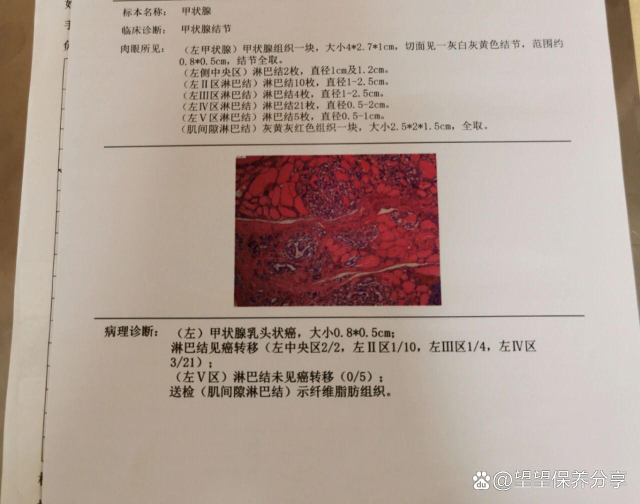 甲癌 淋巴转移病理报告