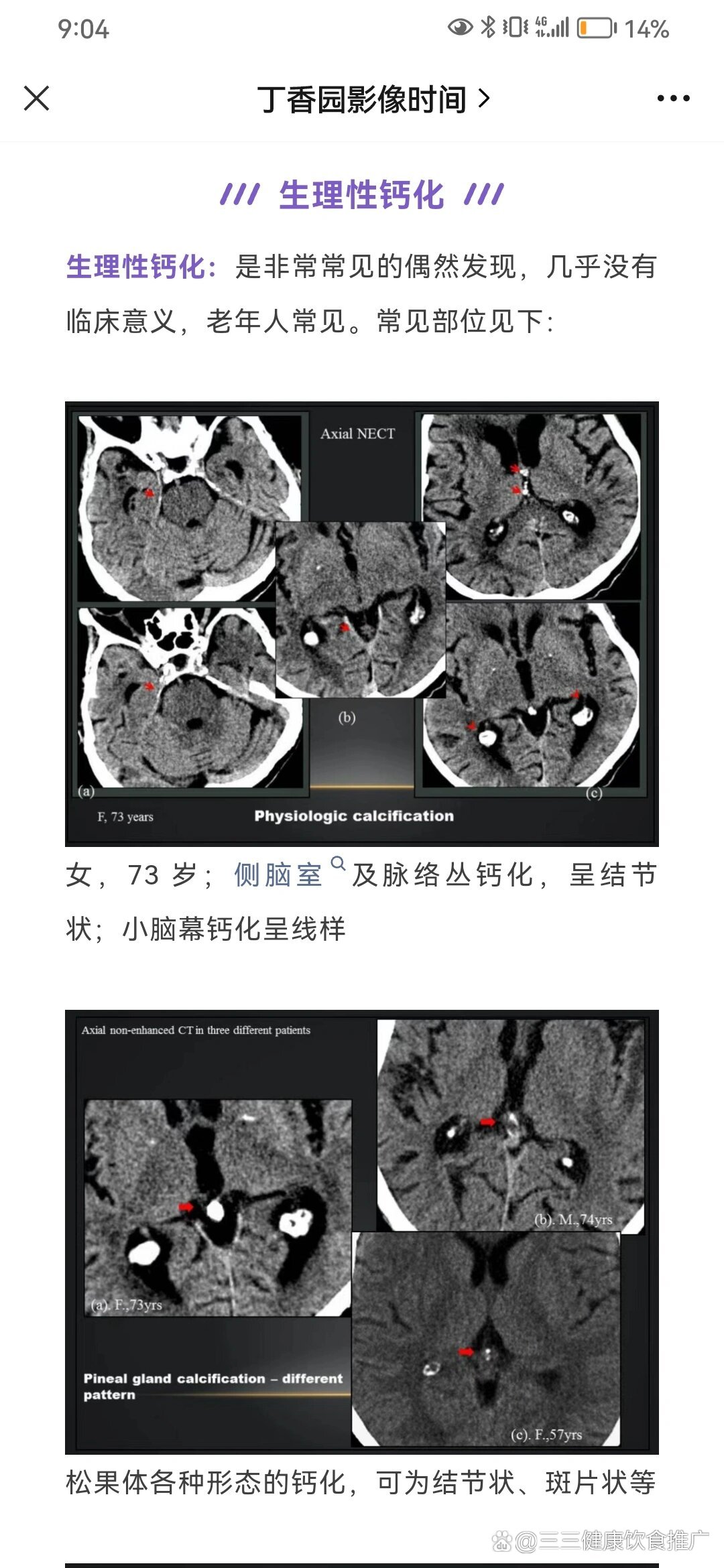常见颅脑生理性钙化
