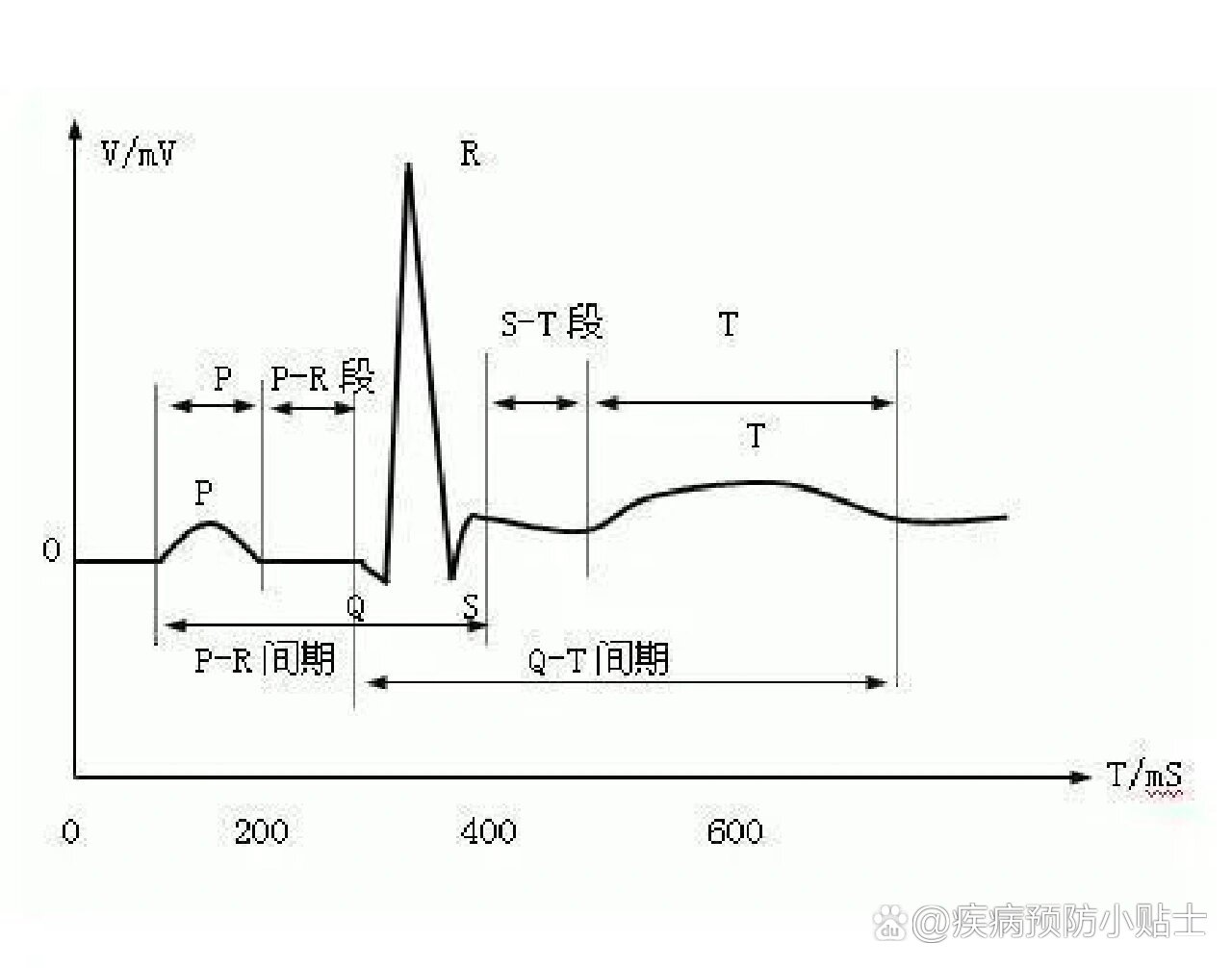 t波高尖心电图表现图片