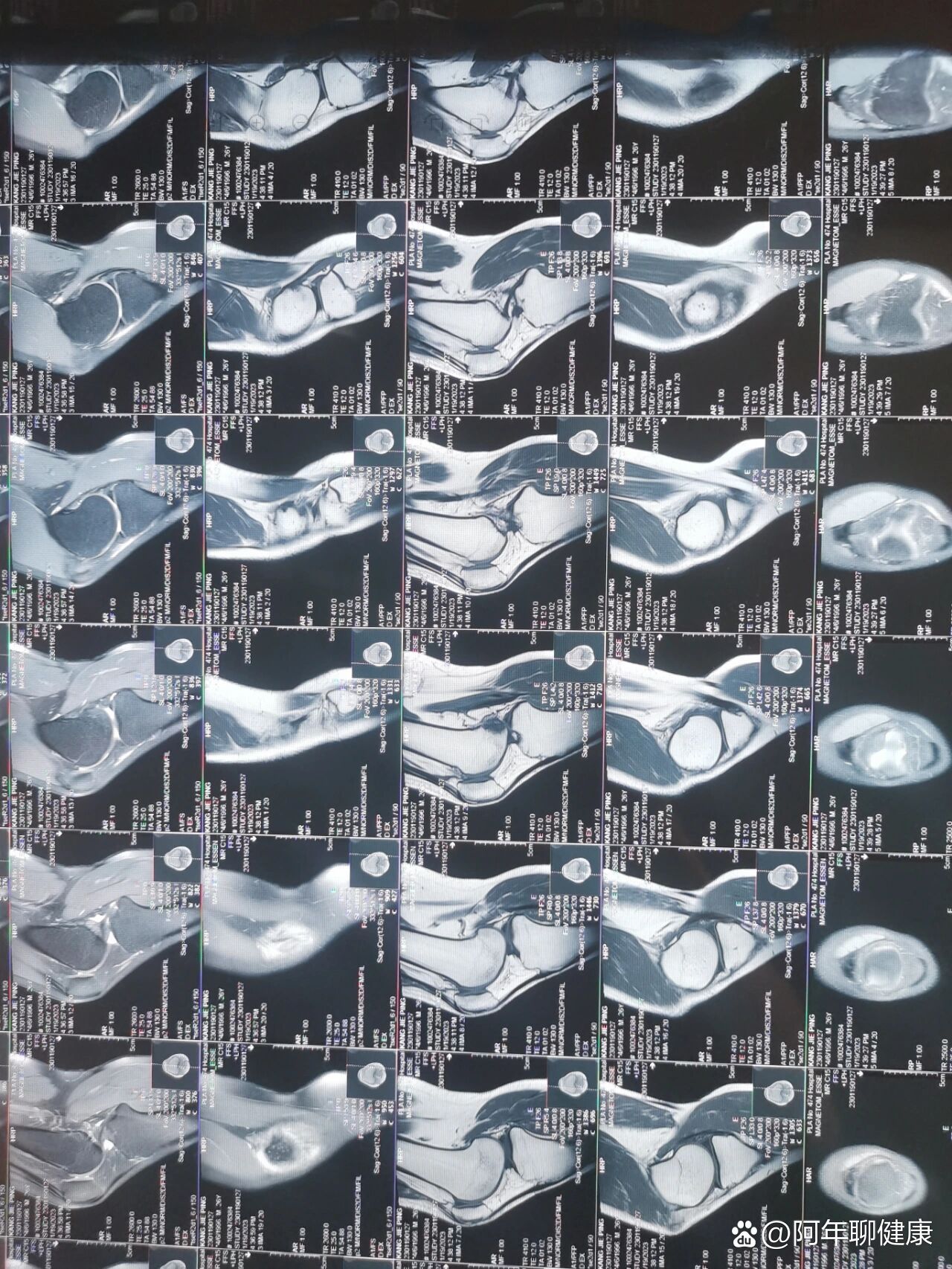 膝盖韧带损伤三个医院三个诊断
