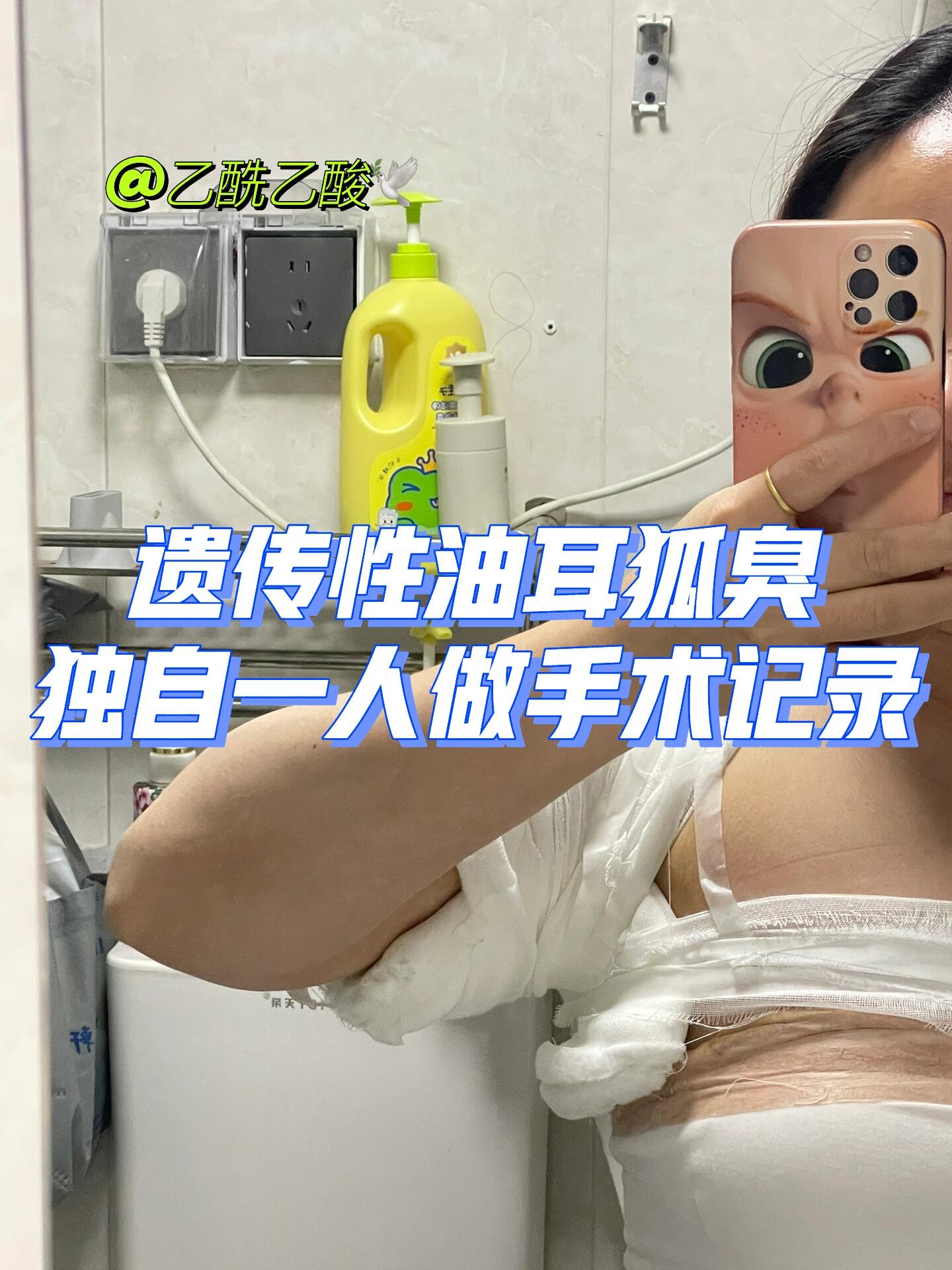 遗传性油耳狐臭|独自一人做手术记录95