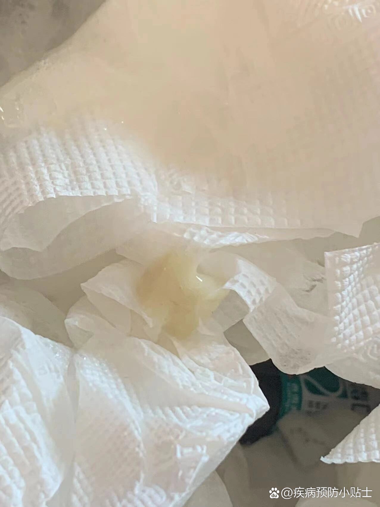 新冠不发烧但咳黄痰