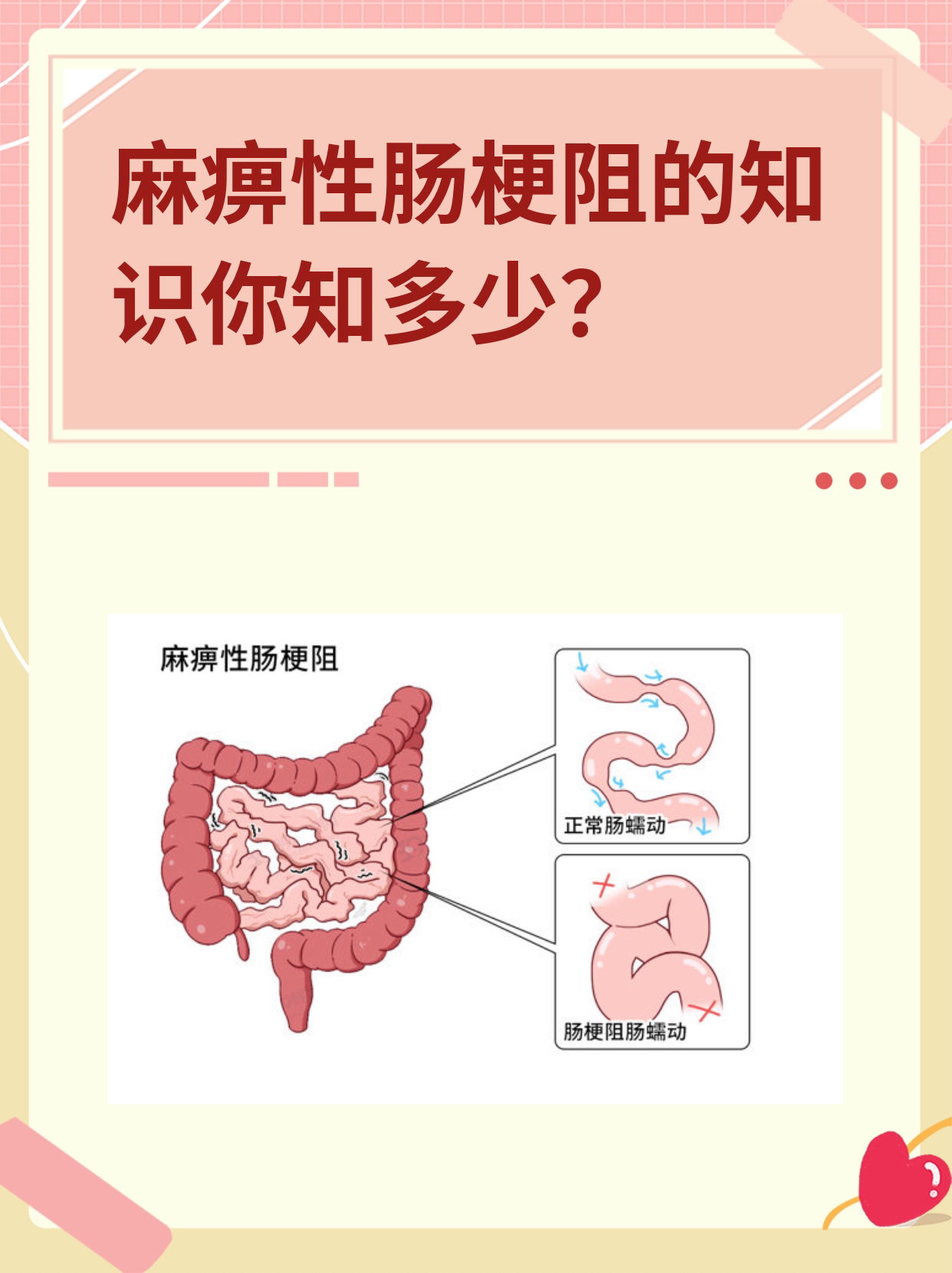 麻痹性肠梗阻的知识你知多少