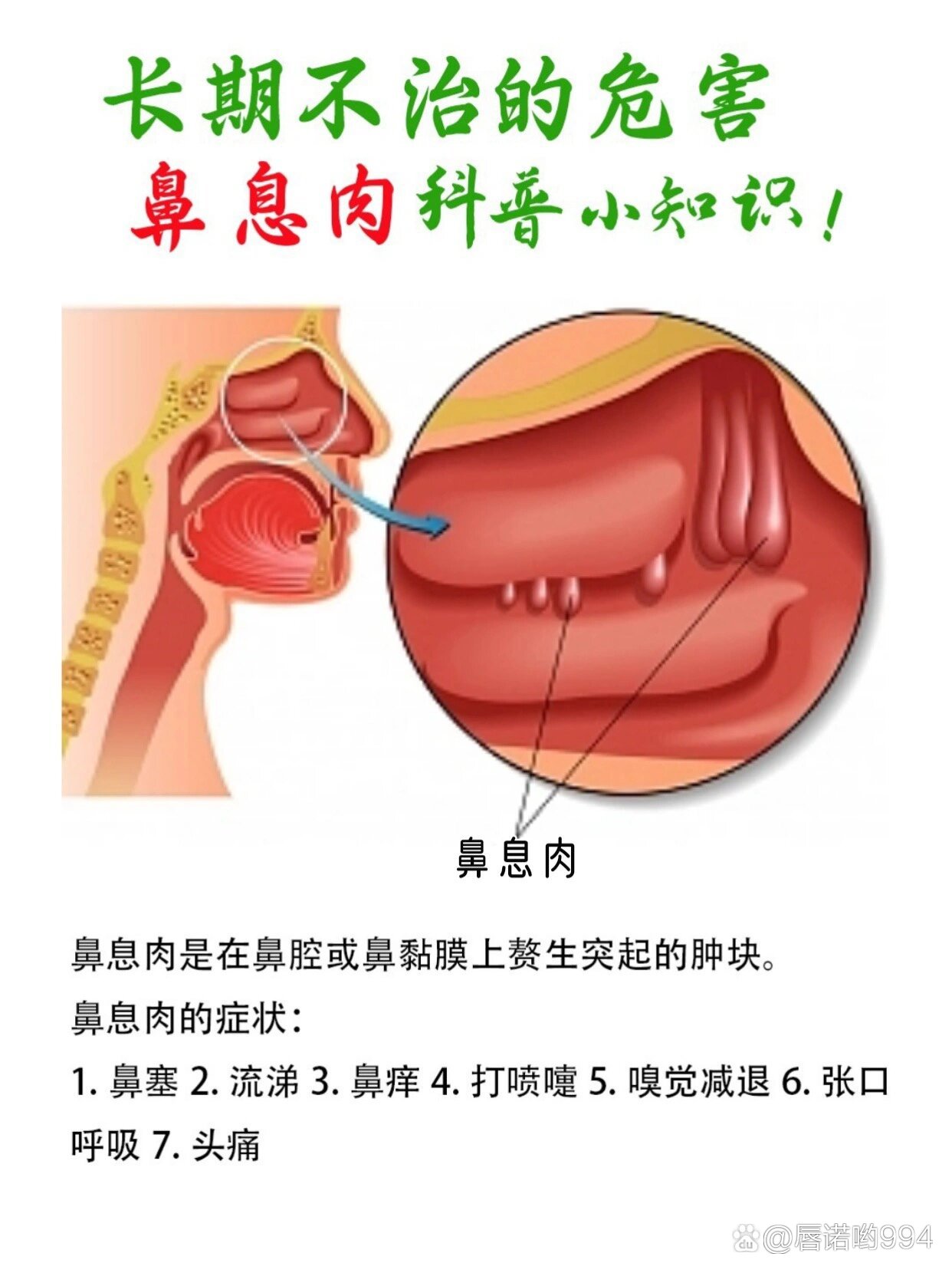 鼻息肉严重的图片图片