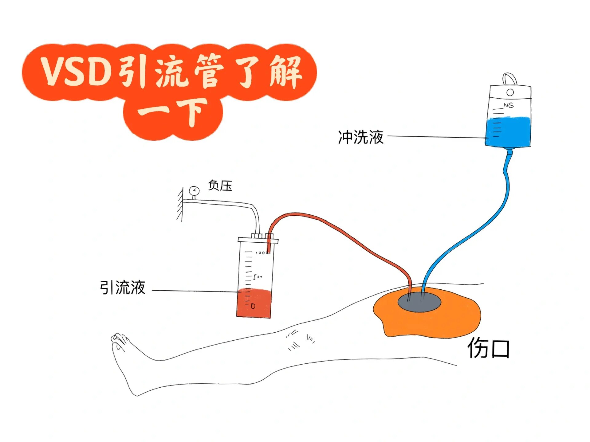 sealing drainage br>负压封闭引流技术(vacuum sealing drainage,vsd