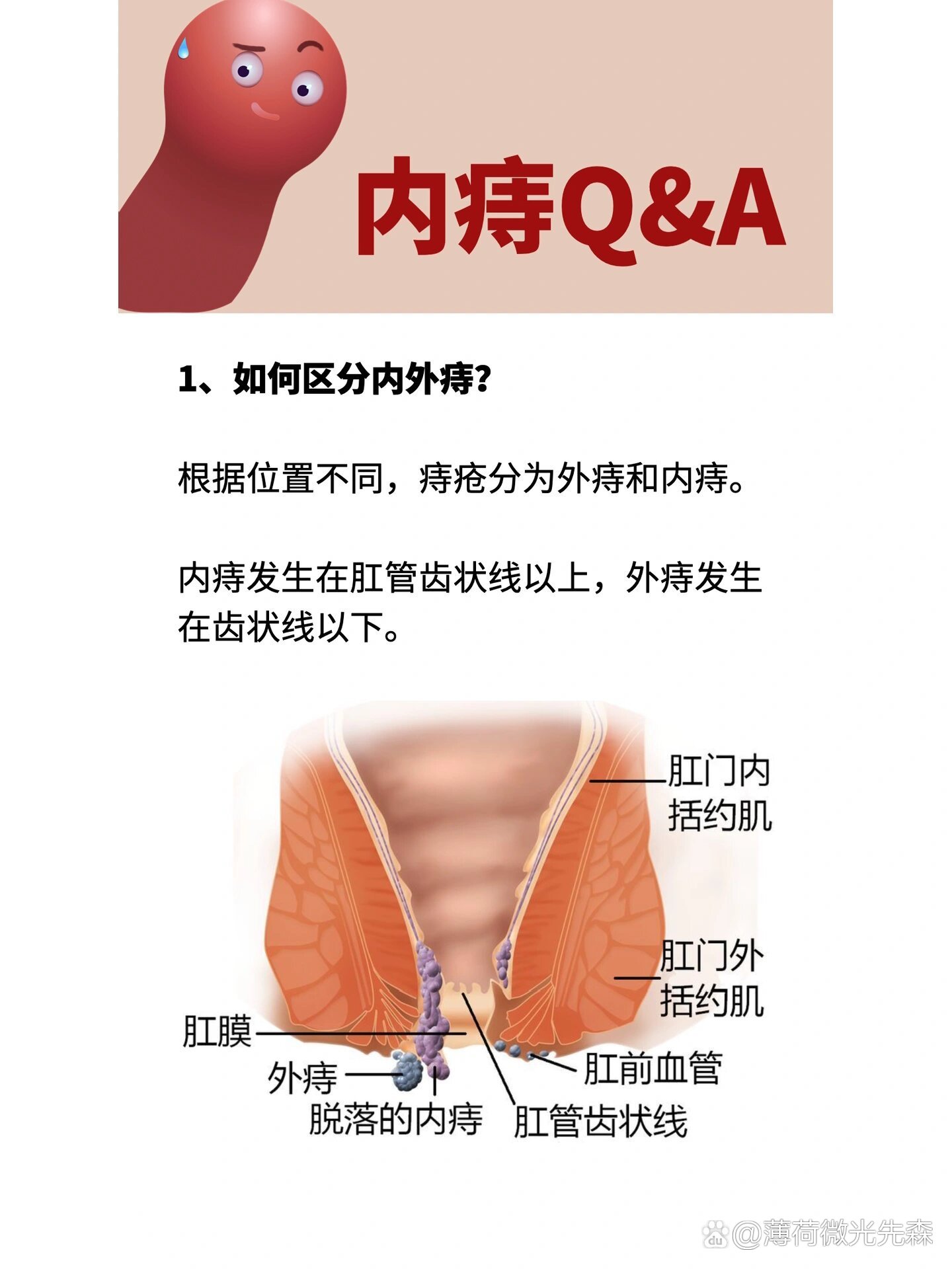 肛门外长痔疮图片图片