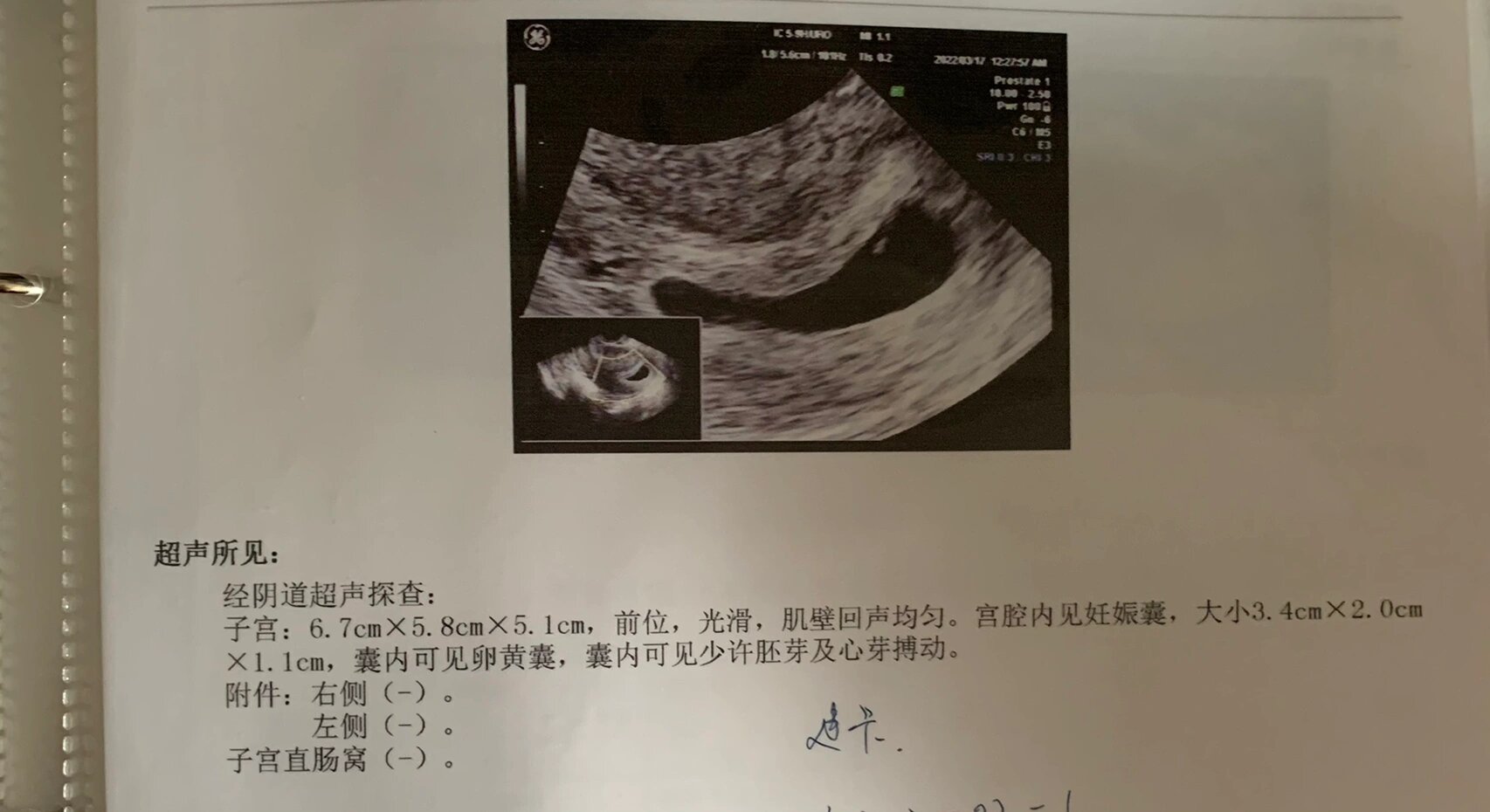 前期孕囊茄子型,姐妹们啥型?