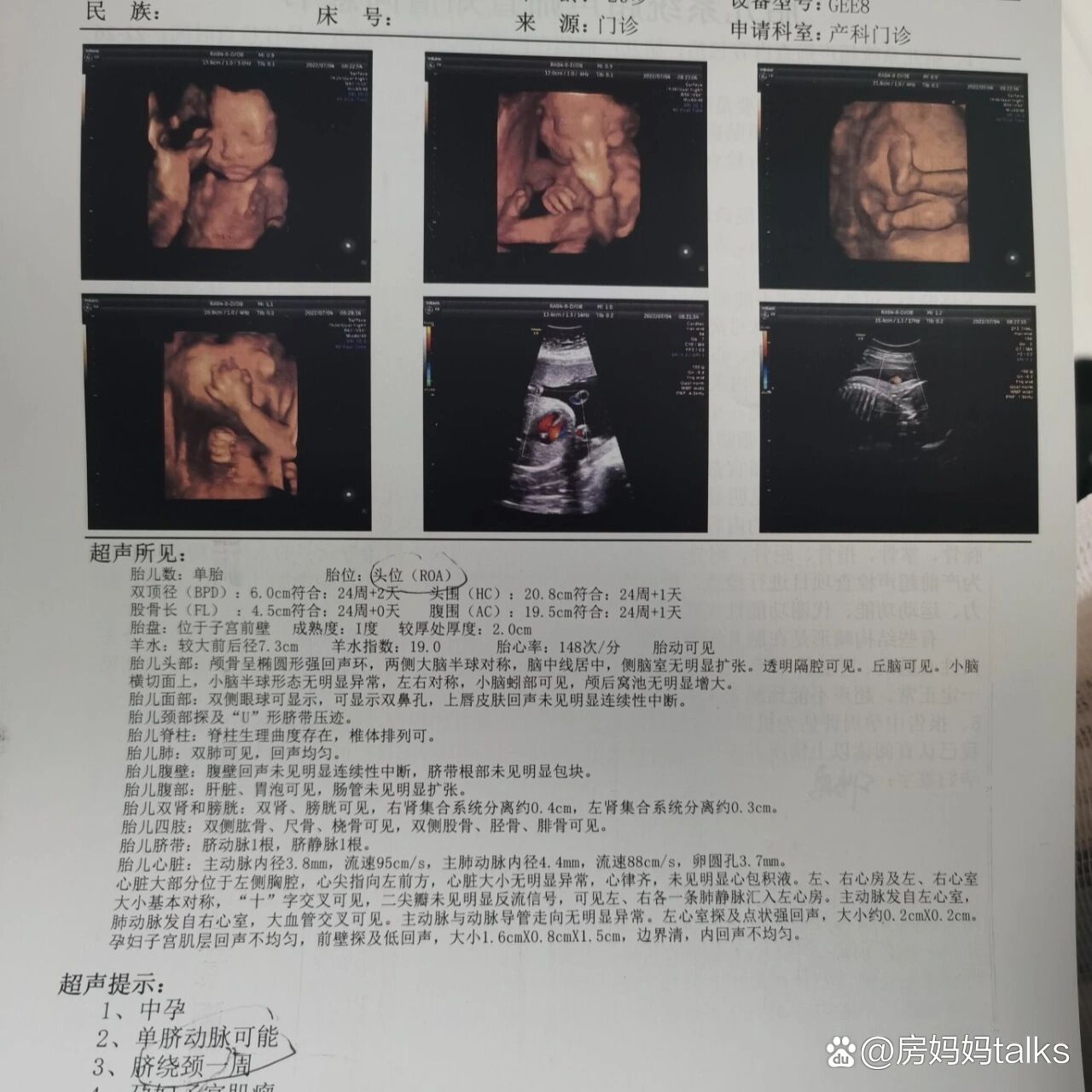 我的单脐动脉宝宝顺利通过四维啦