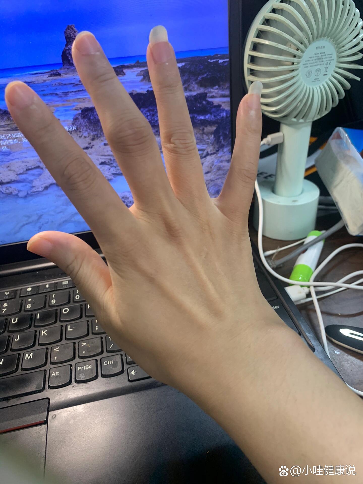 类风湿性关节炎的中指