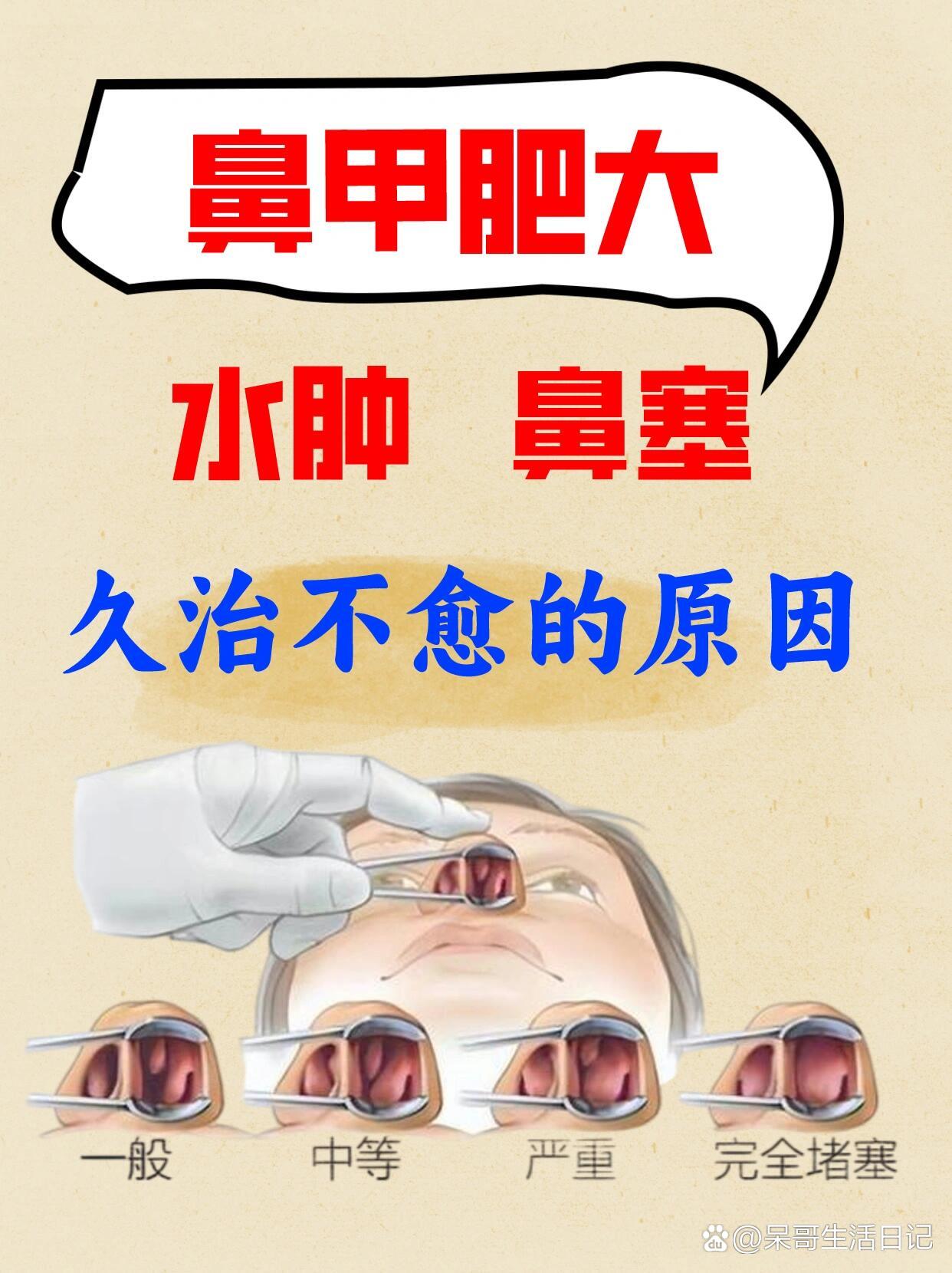 鼻甲肥大,水肿,鼻塞久治不愈的原因!