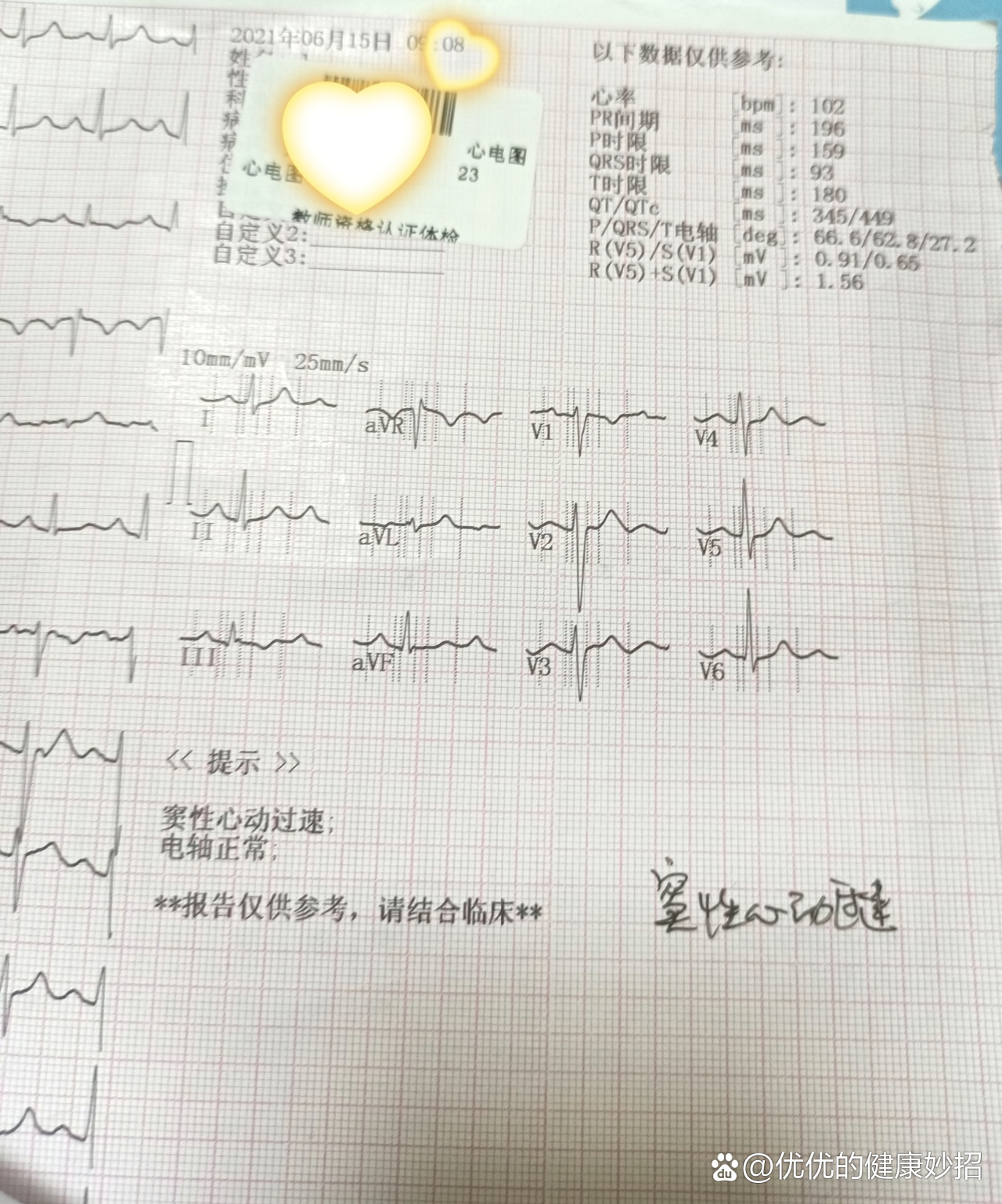 年轻女性窦性心动过速图片