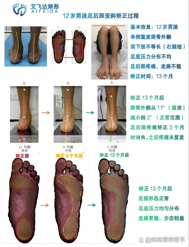 【案例分享】12岁男孩足后跟歪斜矫正