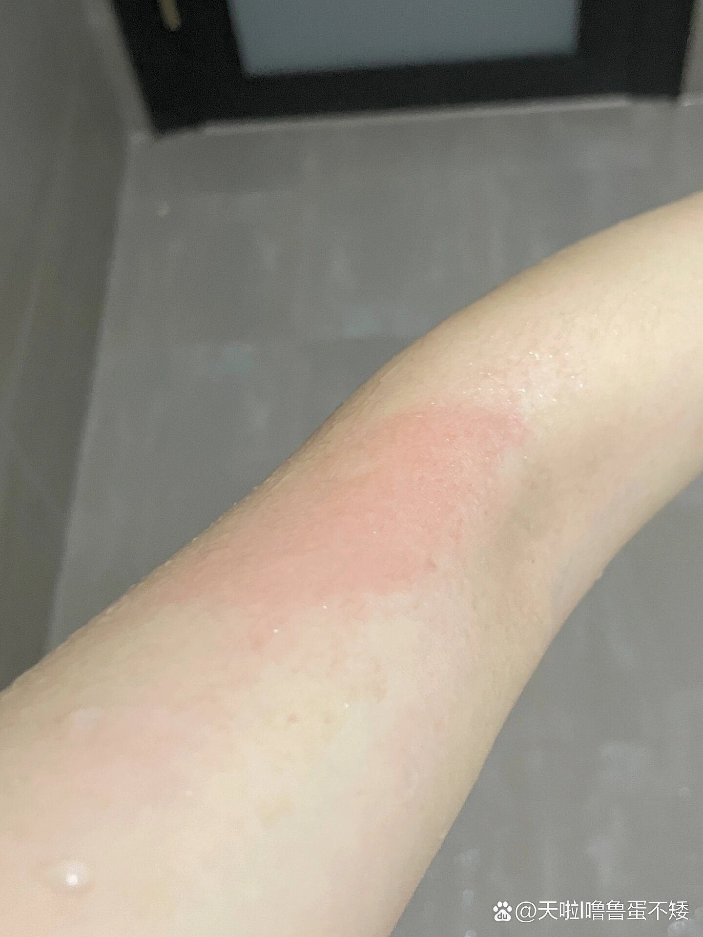 洗澡后红一块一块的