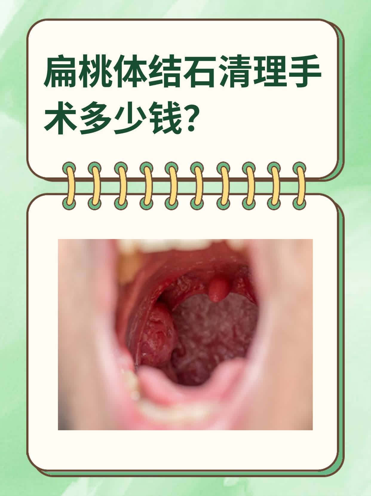 扁桃体结石清理手术多少钱
