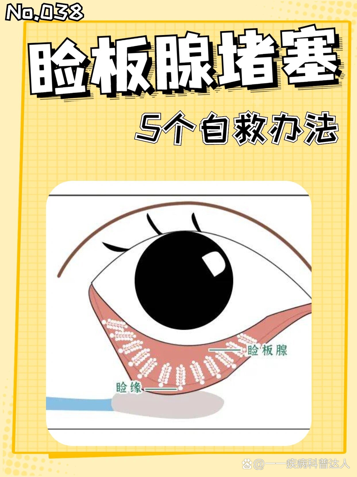 👉细说5个在家疏通睑板腺堵塞的自救办法