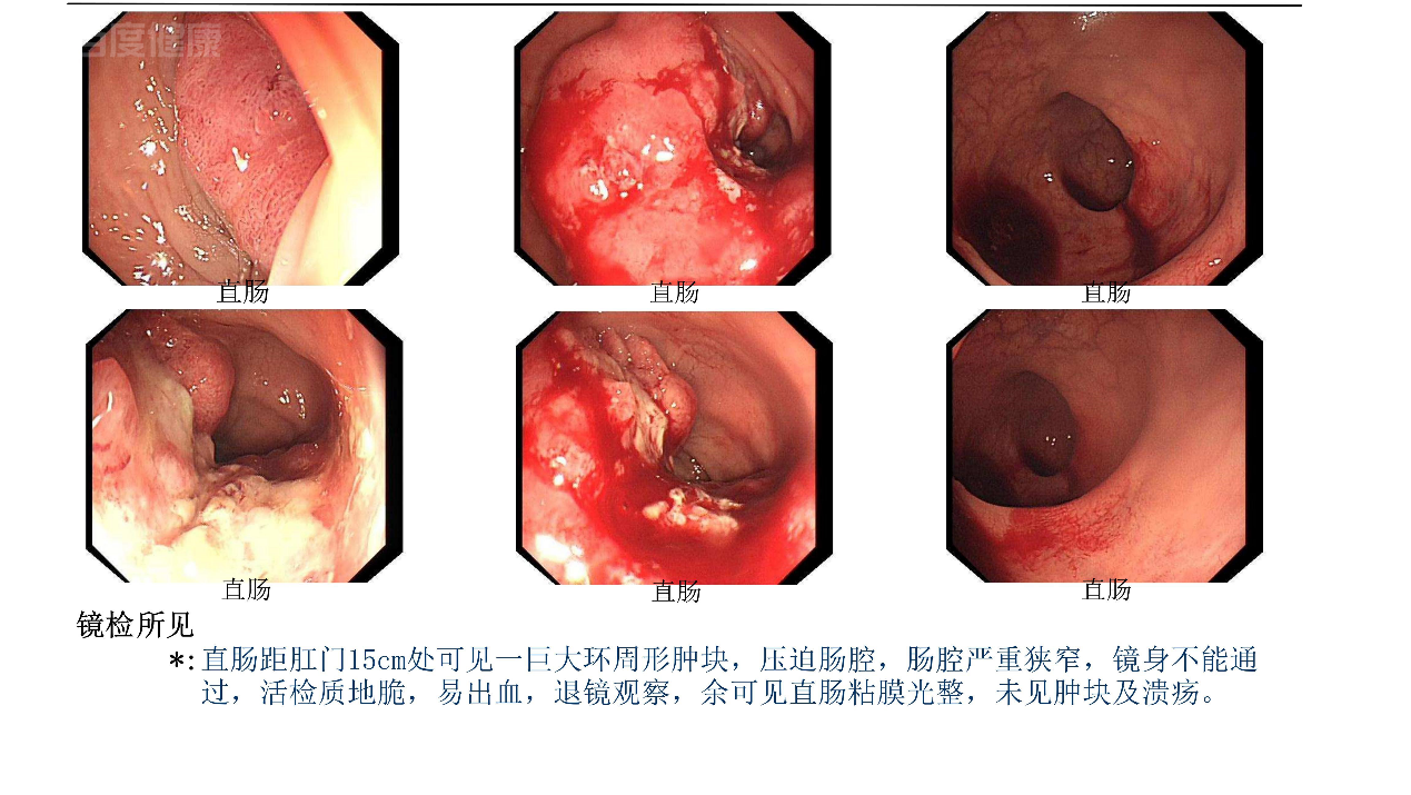 肠镜发现管状绒毛状腺瘤后手术切除恢复良好