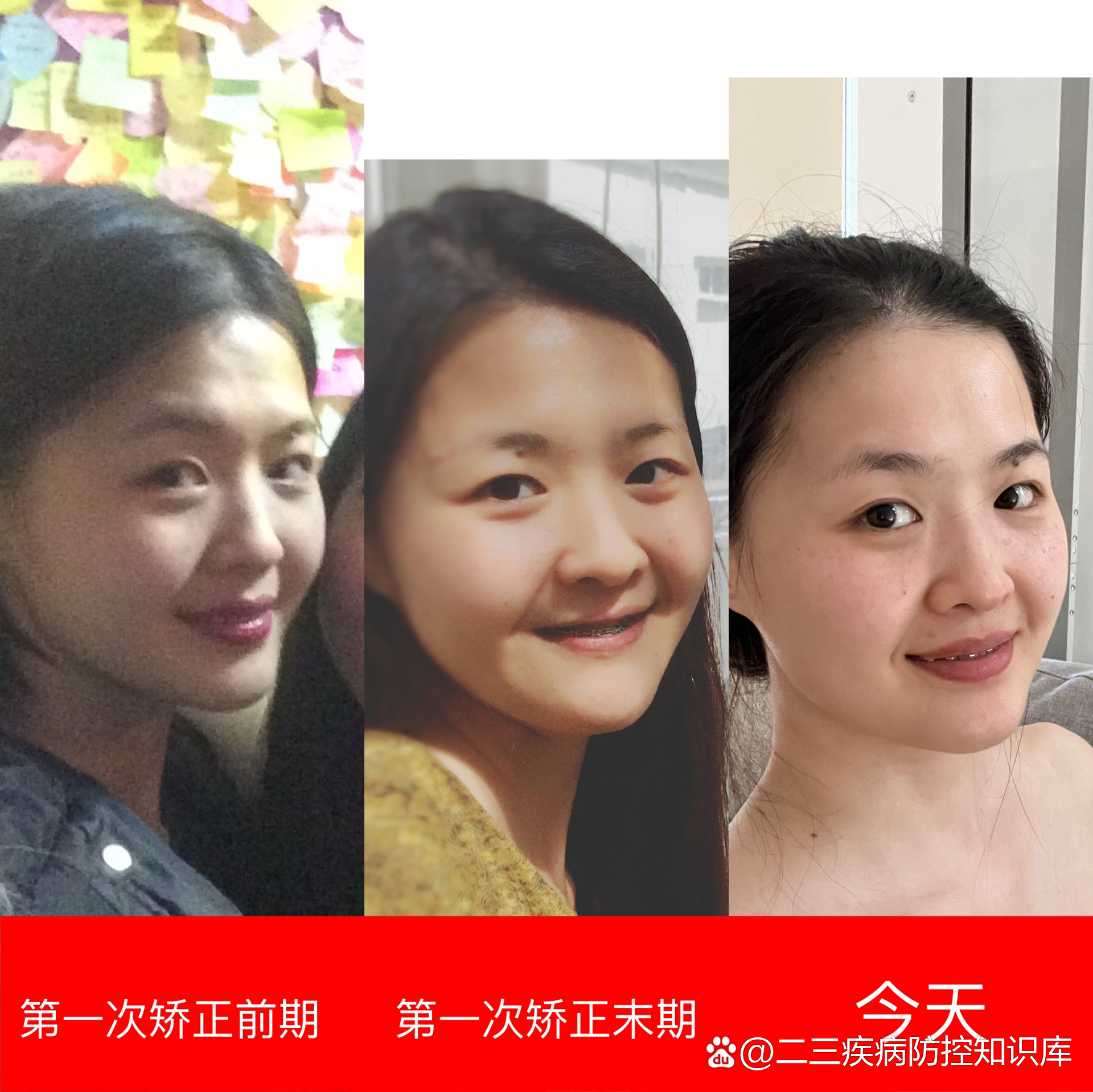 正畸瘪嘴,反向外推,脸部对比图