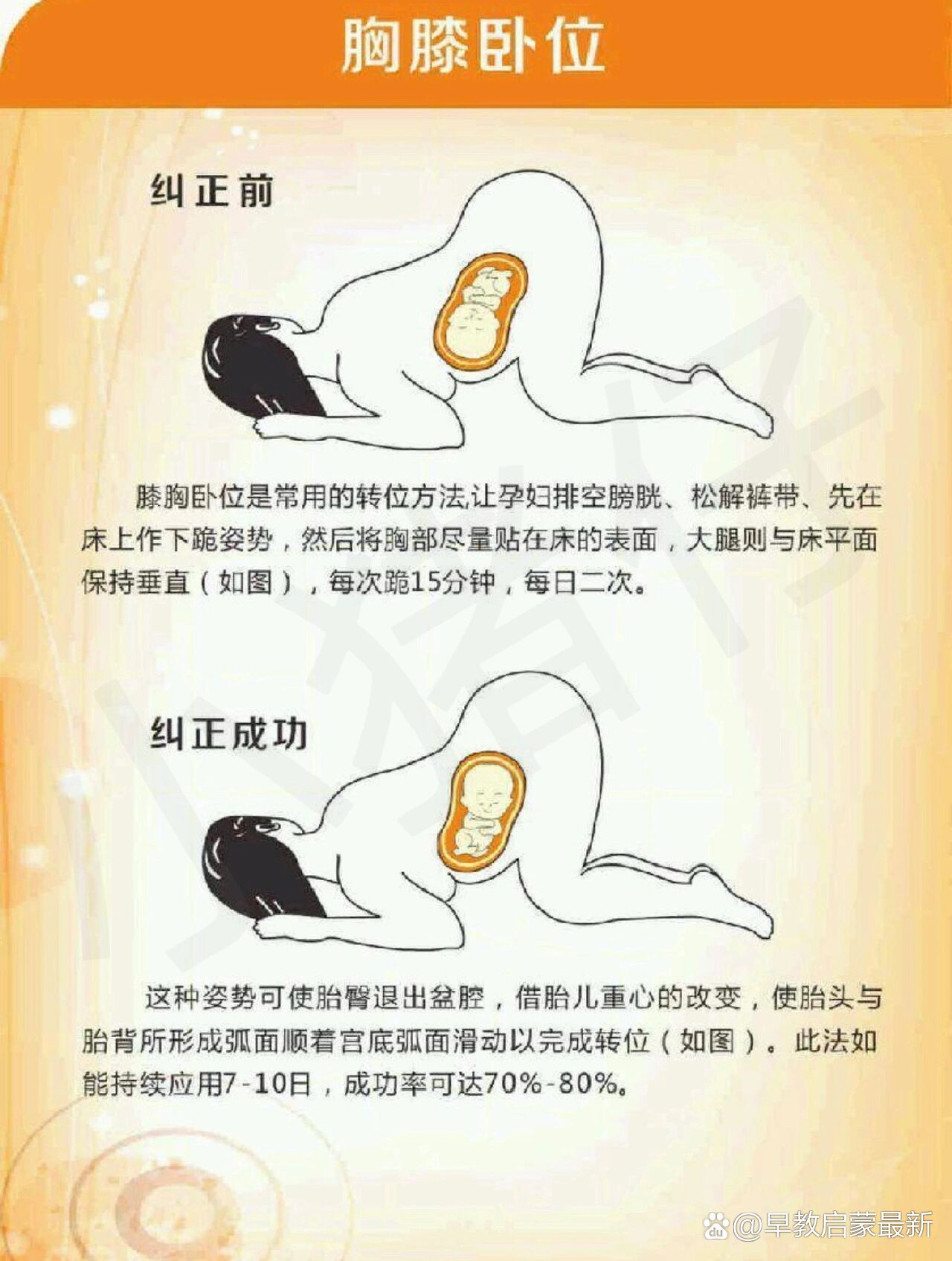 发现单子上的胎位由以前的loa变成了lop,于是搜集整理了胎位的分类