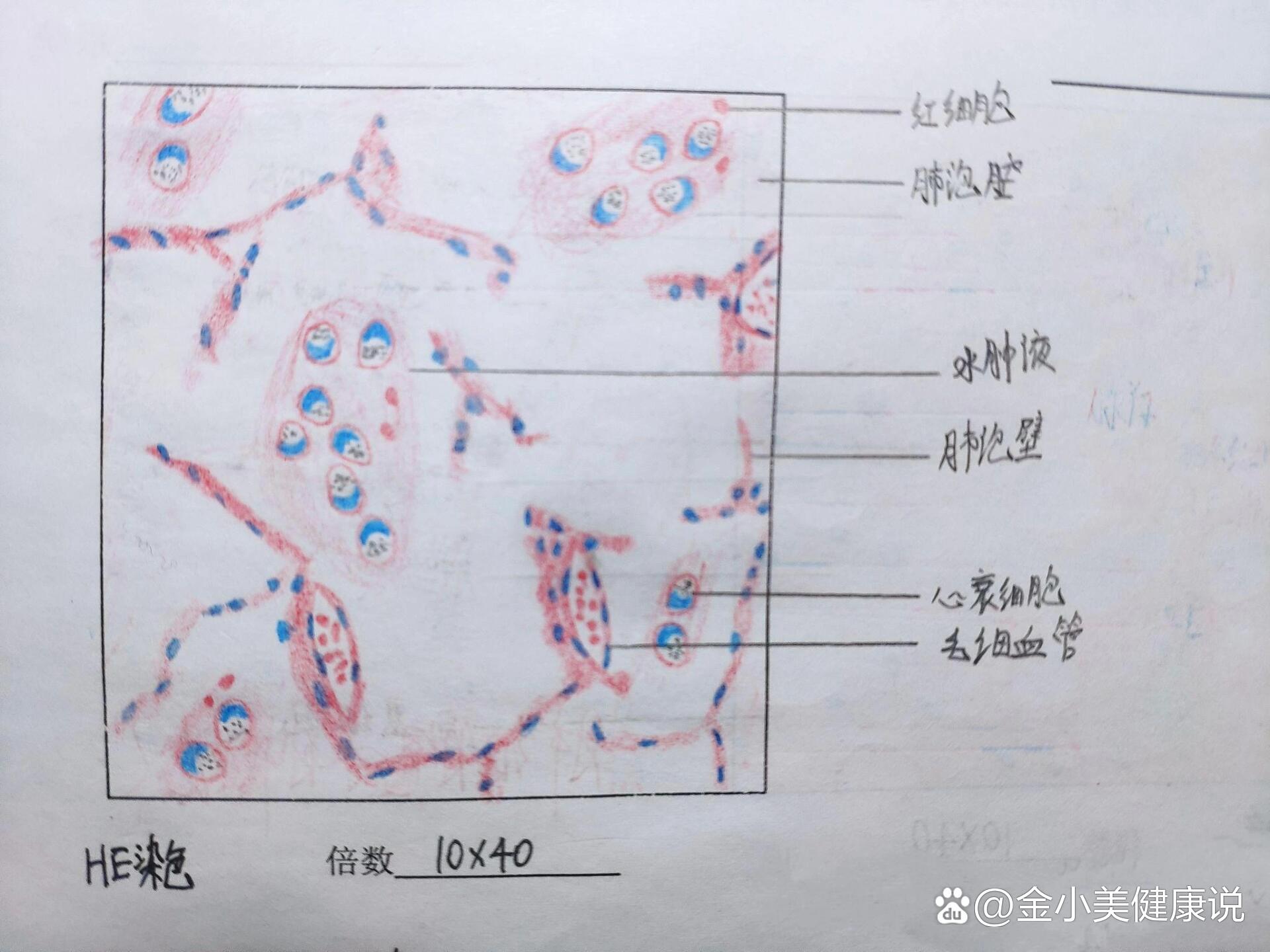 肺水肿红蓝铅笔图片