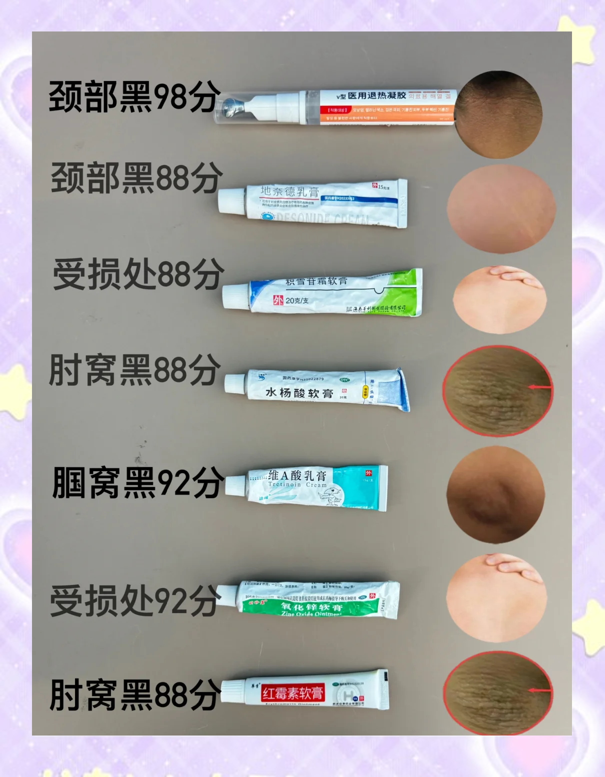 黑棘皮药膏推荐与使用心得
