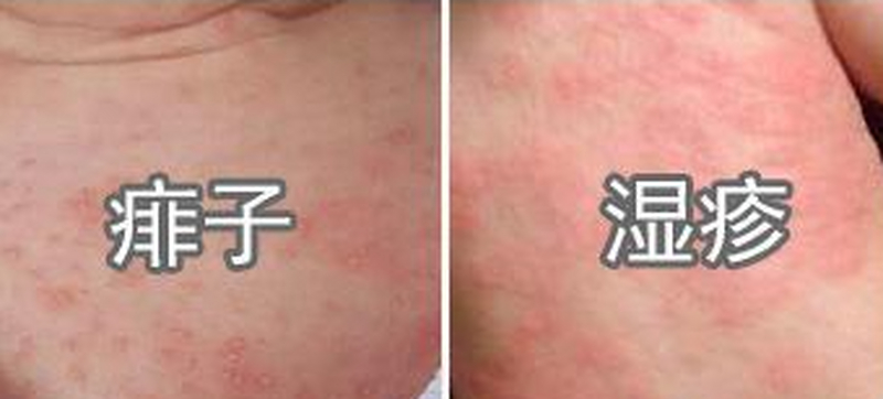 湿疹热疹如何区分？