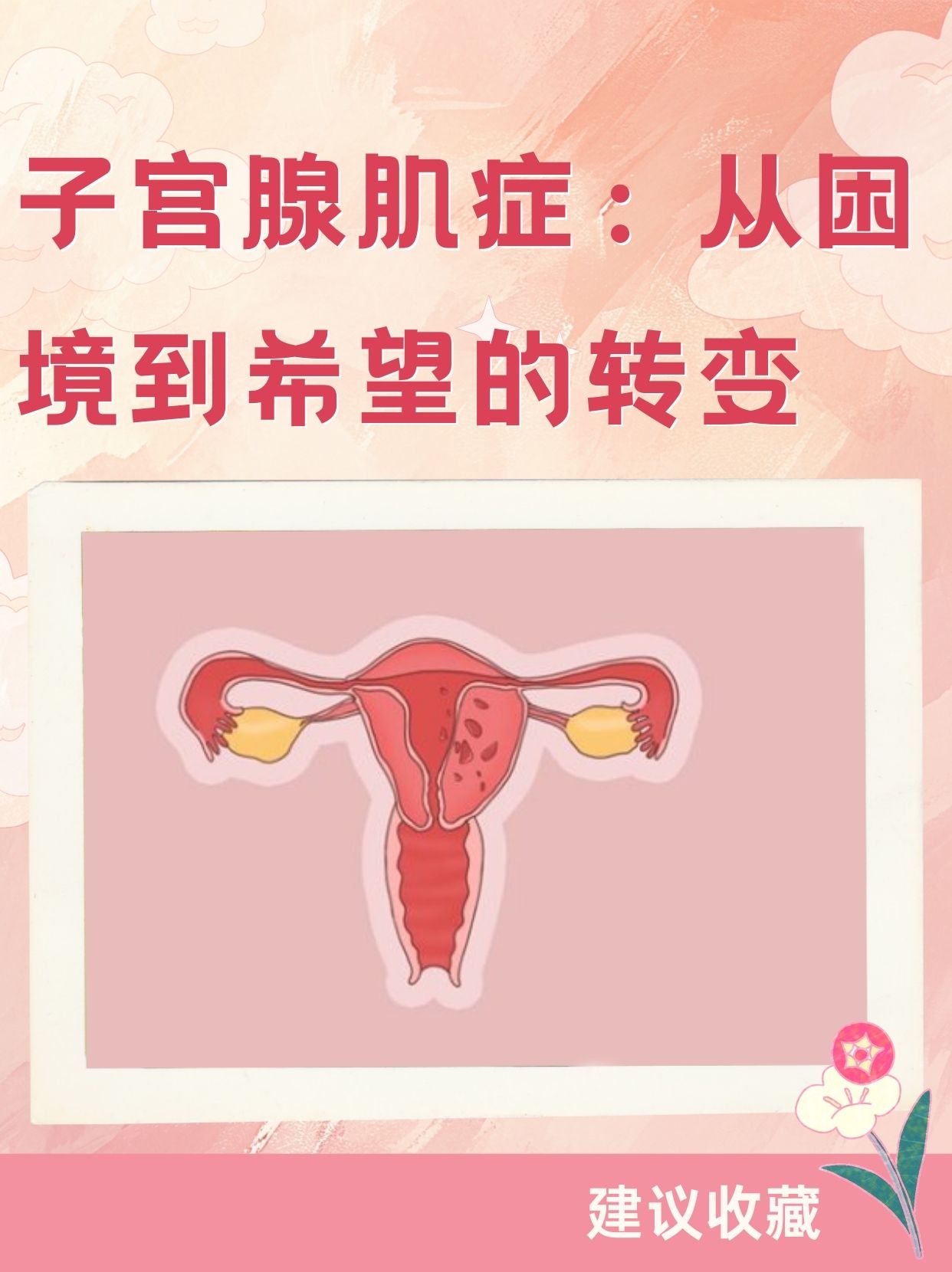 子宫腺肌症是怎么得的图片