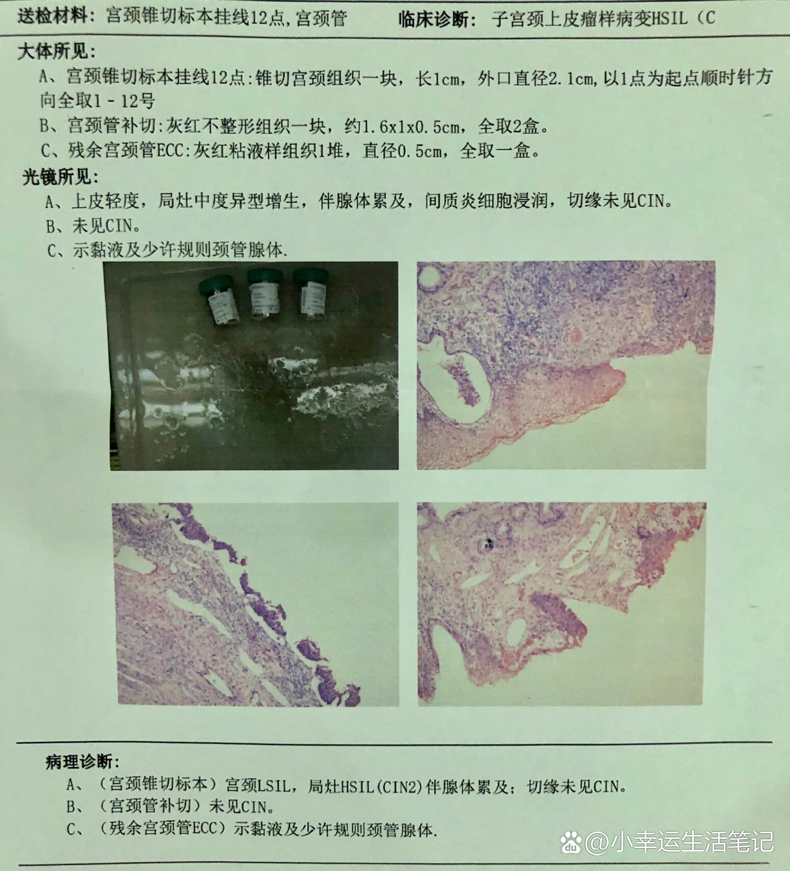 leep大病理报告降级!