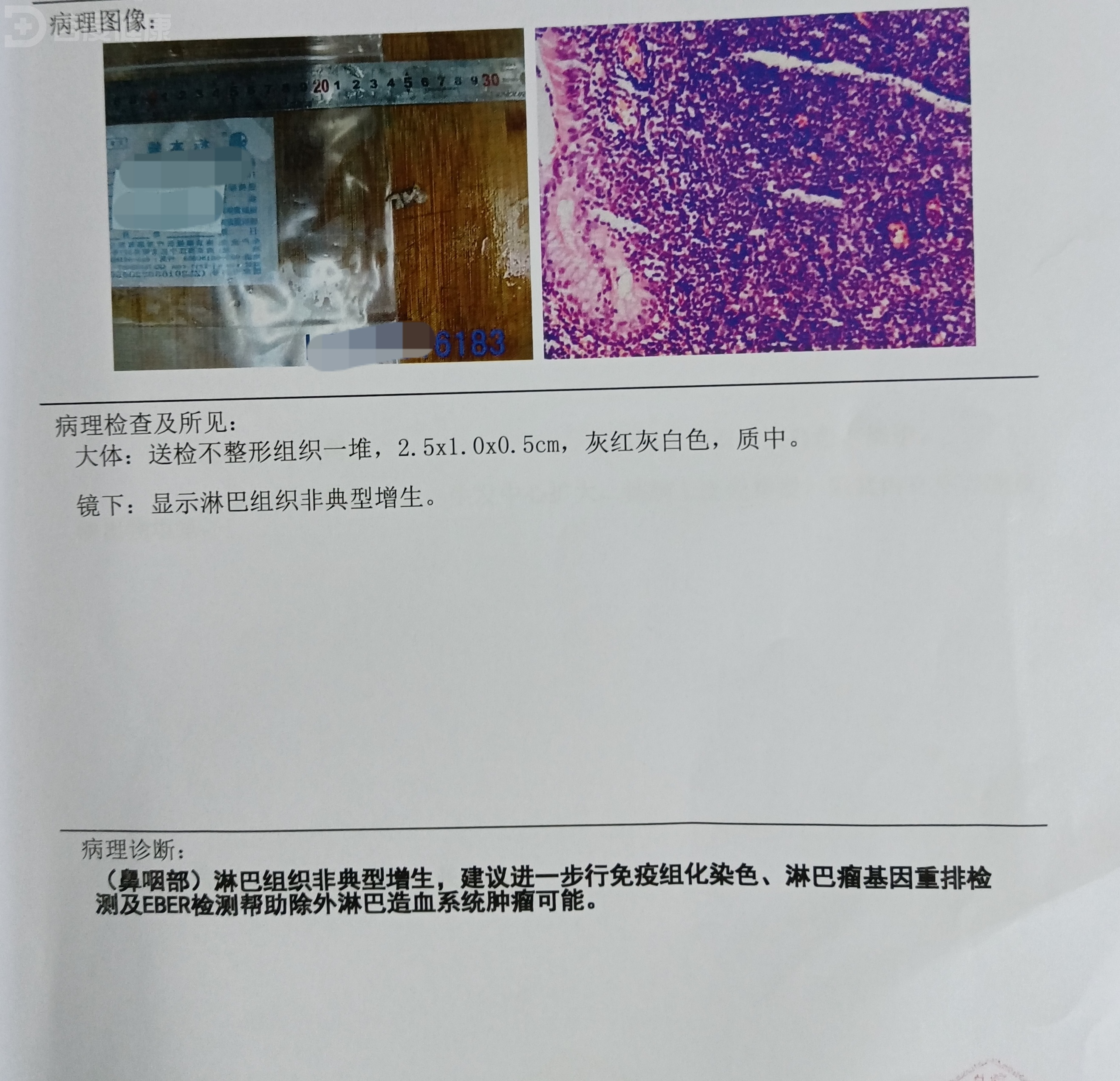 一例鼻咽良性肿瘤的诊治体会