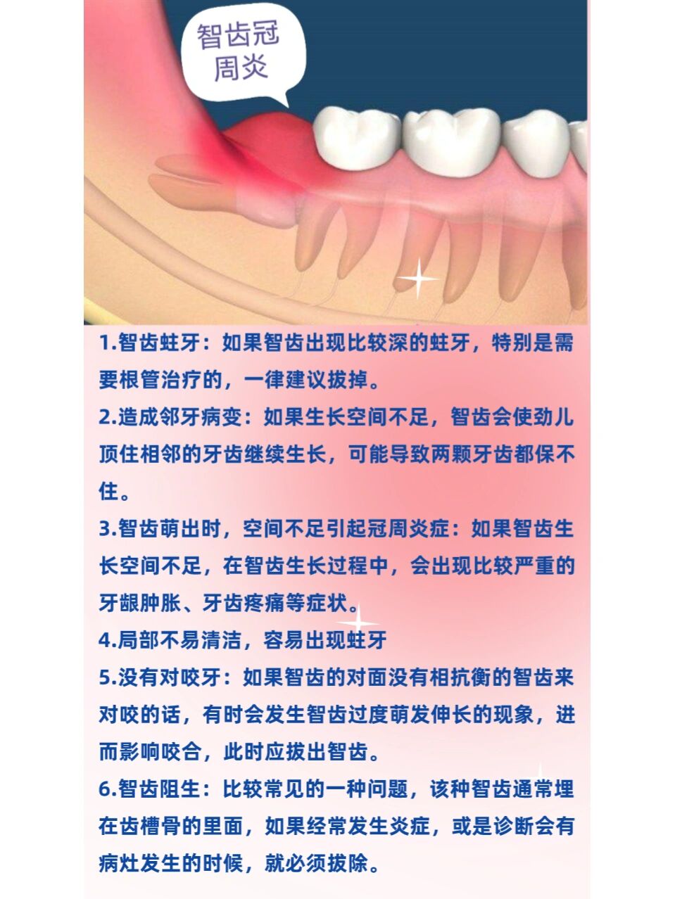 智齿是干嘛的为什么要拔智齿为什么在线 智齿是干嘛的为什么要拔智齿为什么在线