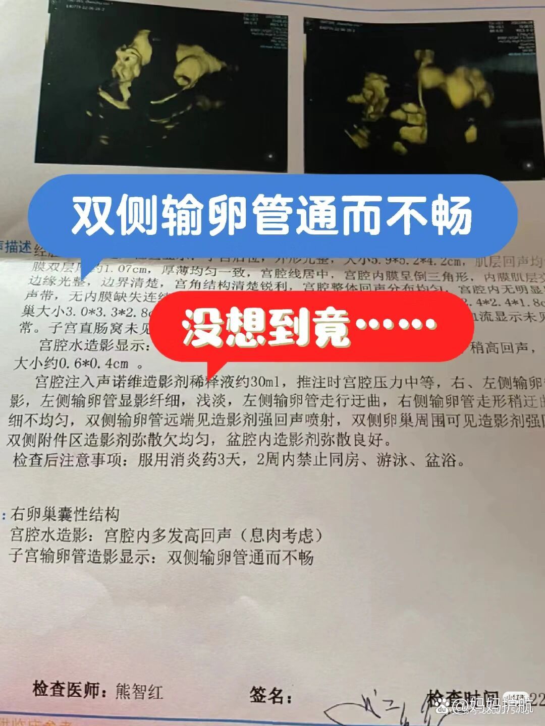 双侧输卵管通而不畅,没想到竟然也怀了