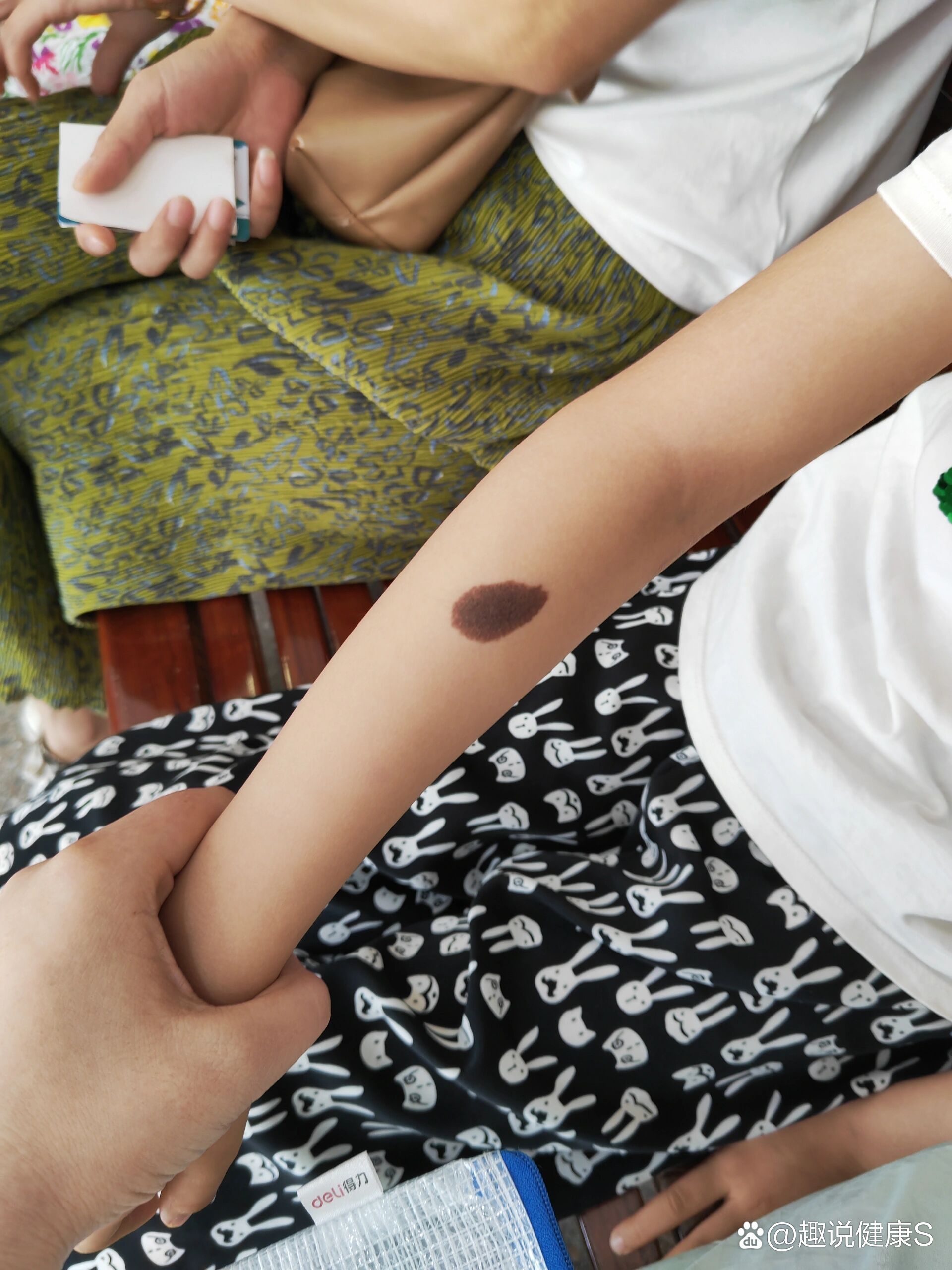 合肥一附院绩溪路胎记去除