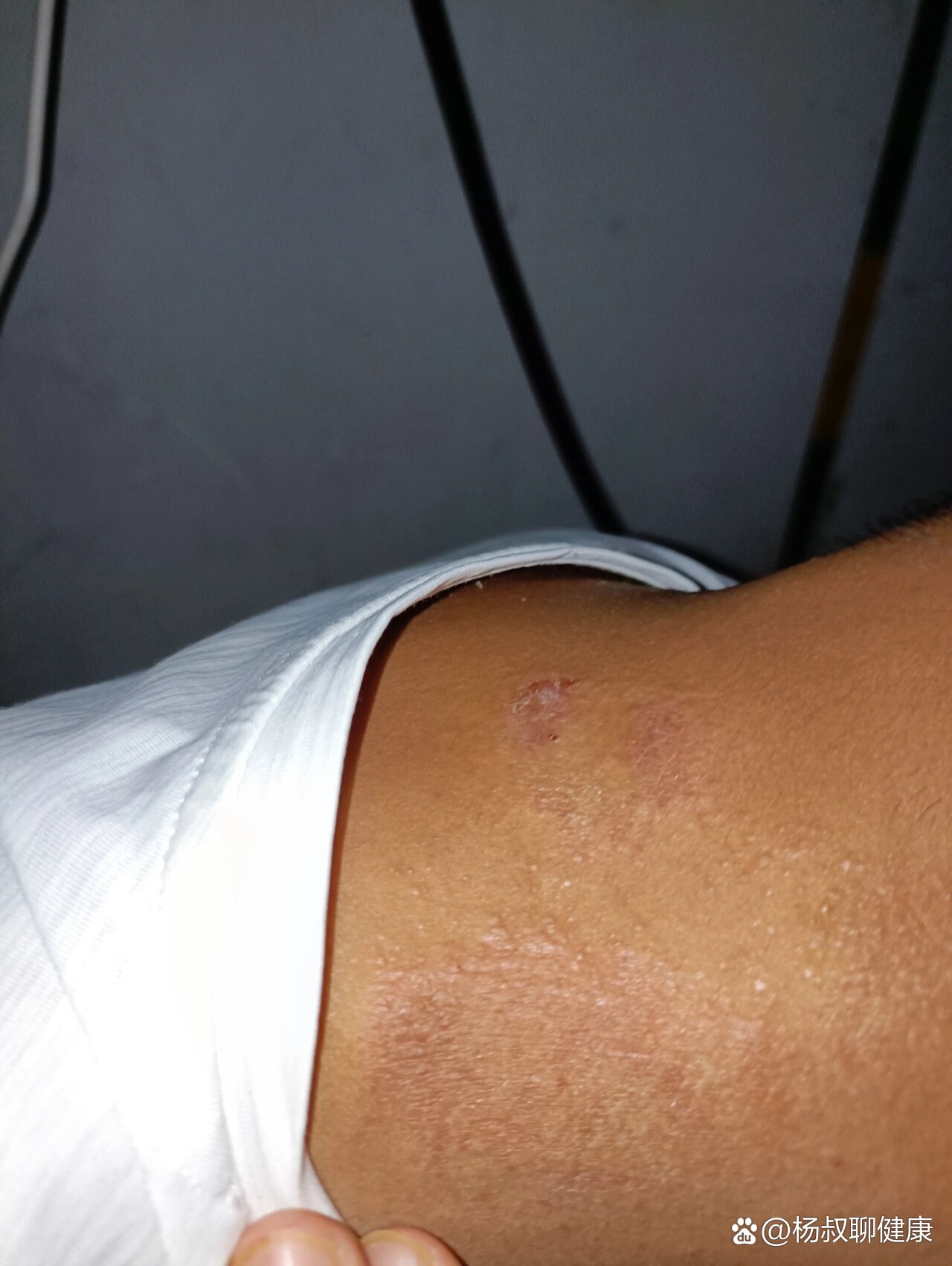 要勤洗手,不能乱抓,又痒又干还脱屑